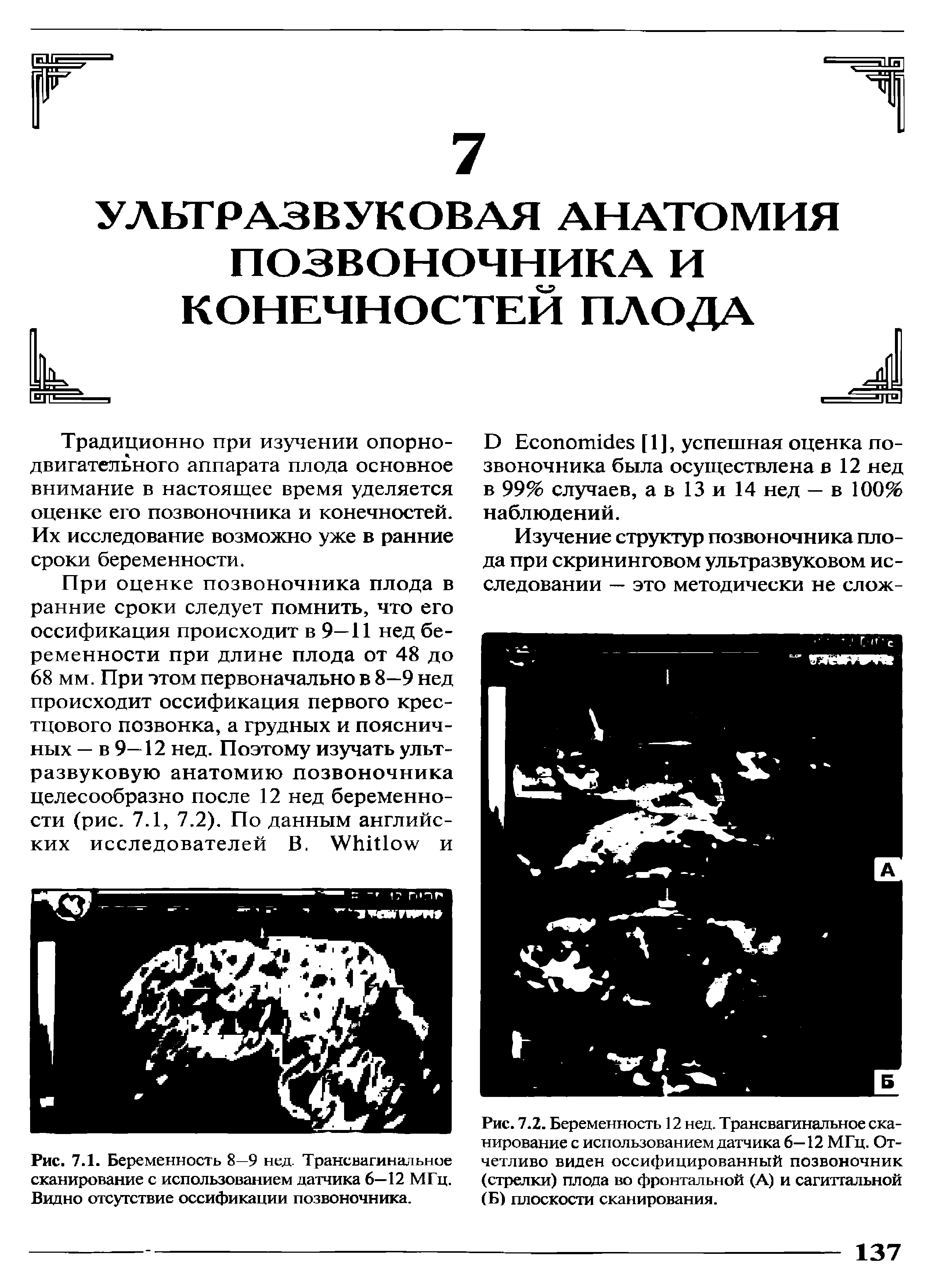 Рис. 7.1. Беременность 8—9 нед. Трансвагинальное сканирование с использованием датчика 6—12 МГц. Видно отсутствие оссификация позвоночника.