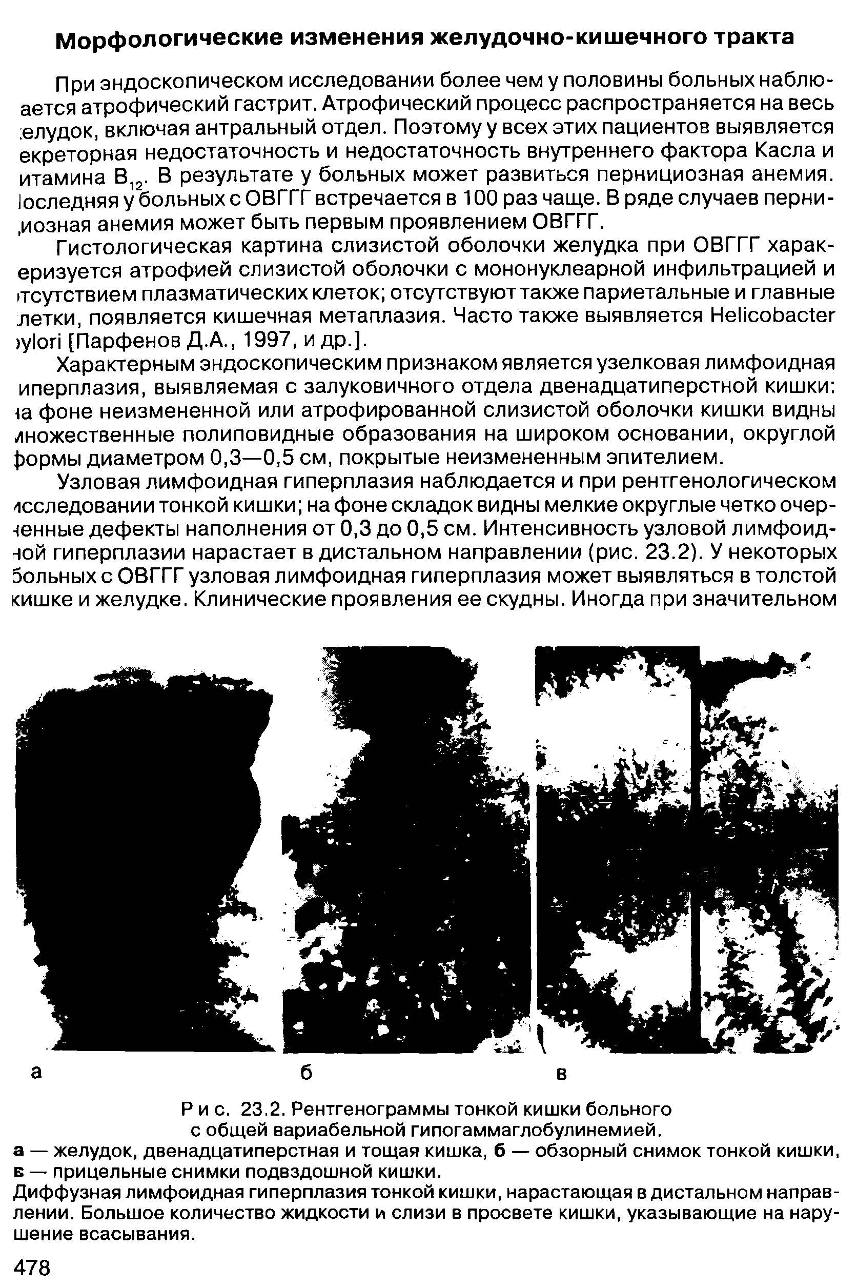 Рис. 23.2. Рентгенограммы тонкой кишки больного с общей вариабельной гипогаммаглобулинемией.