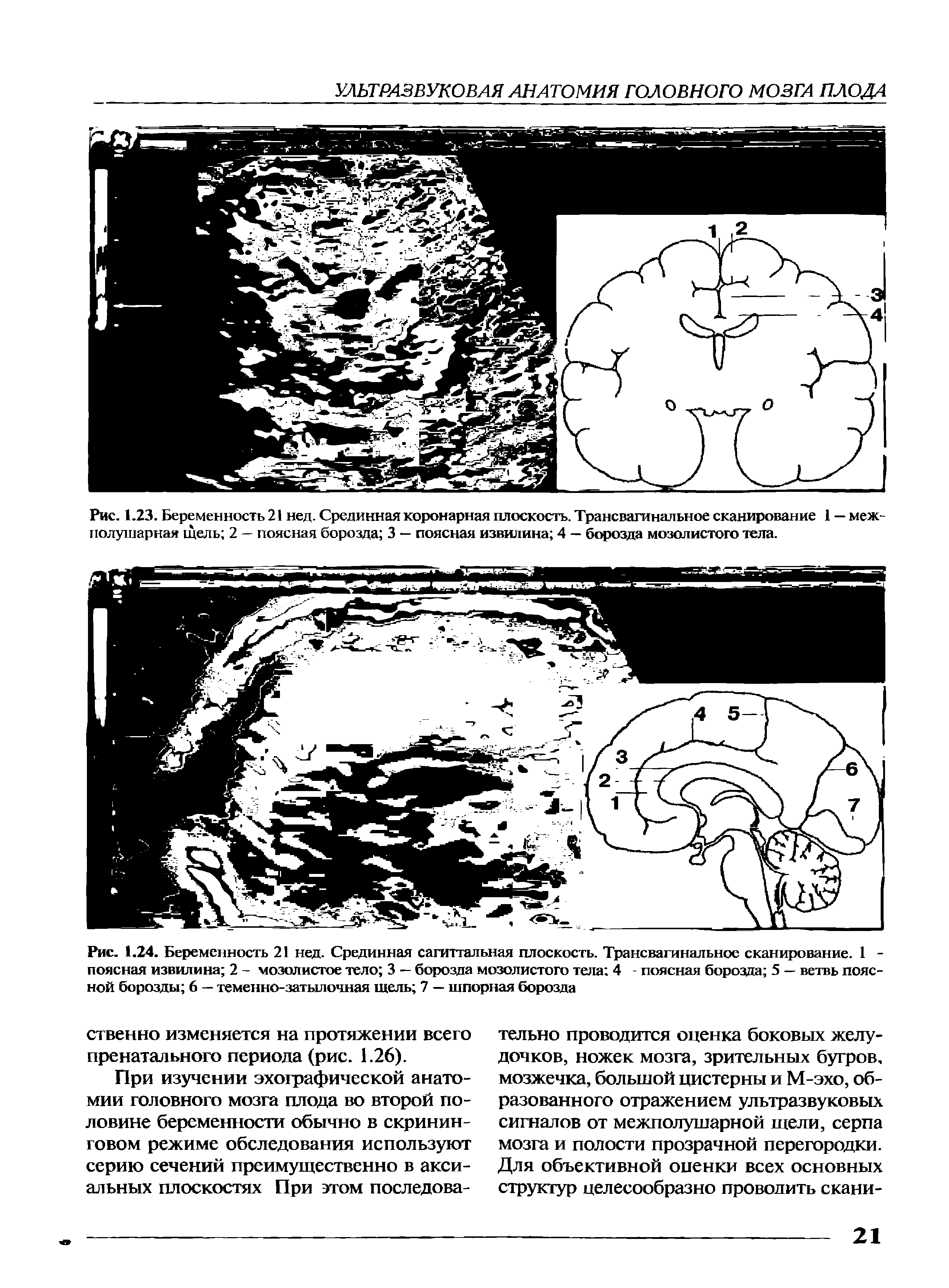 Рис. 1.24. Беременность 21 нед. Срединная сагиттальная плоскость. Трансвагинальное сканирование. 1 -поясная извилина 2 - мозолистое тело 3 — борозда мозолистого тела 4 - поясная борозда 5 — ветвь поясной борозды 6 — теменно-затылочная щель 7 — шпорная борозда...