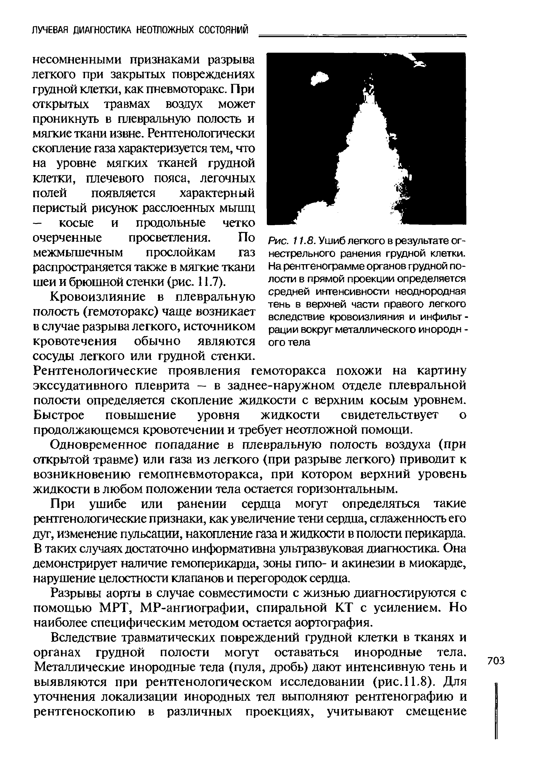 Рис. 11.8. Ушиб легкого в результате огнестрельного ранения грудной клетки. На рентгенограмме органов грудной полости в прямой проекции определяется средней интенсивности неоднородная тень в верхней части правого легкого вследствие кровоизлияния и инфильтрации вокруг металлического инородн -...