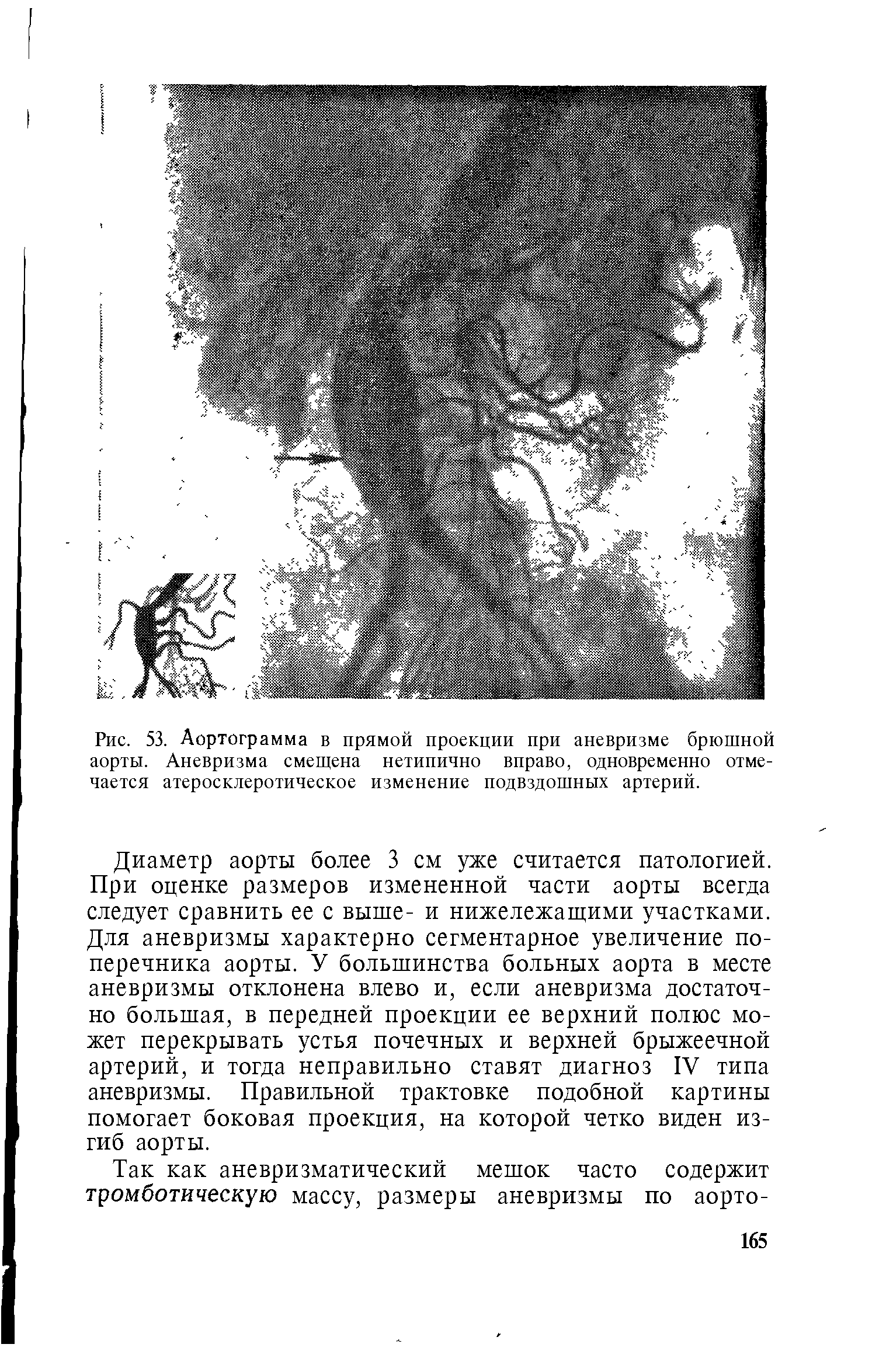 Рис. 53. Аортограмма в прямой проекции при аневризме брюшной аорты. Аневризма смещена нетипично вправо, одновременно отмечается атеросклеротическое изменение подвздошных артерий.