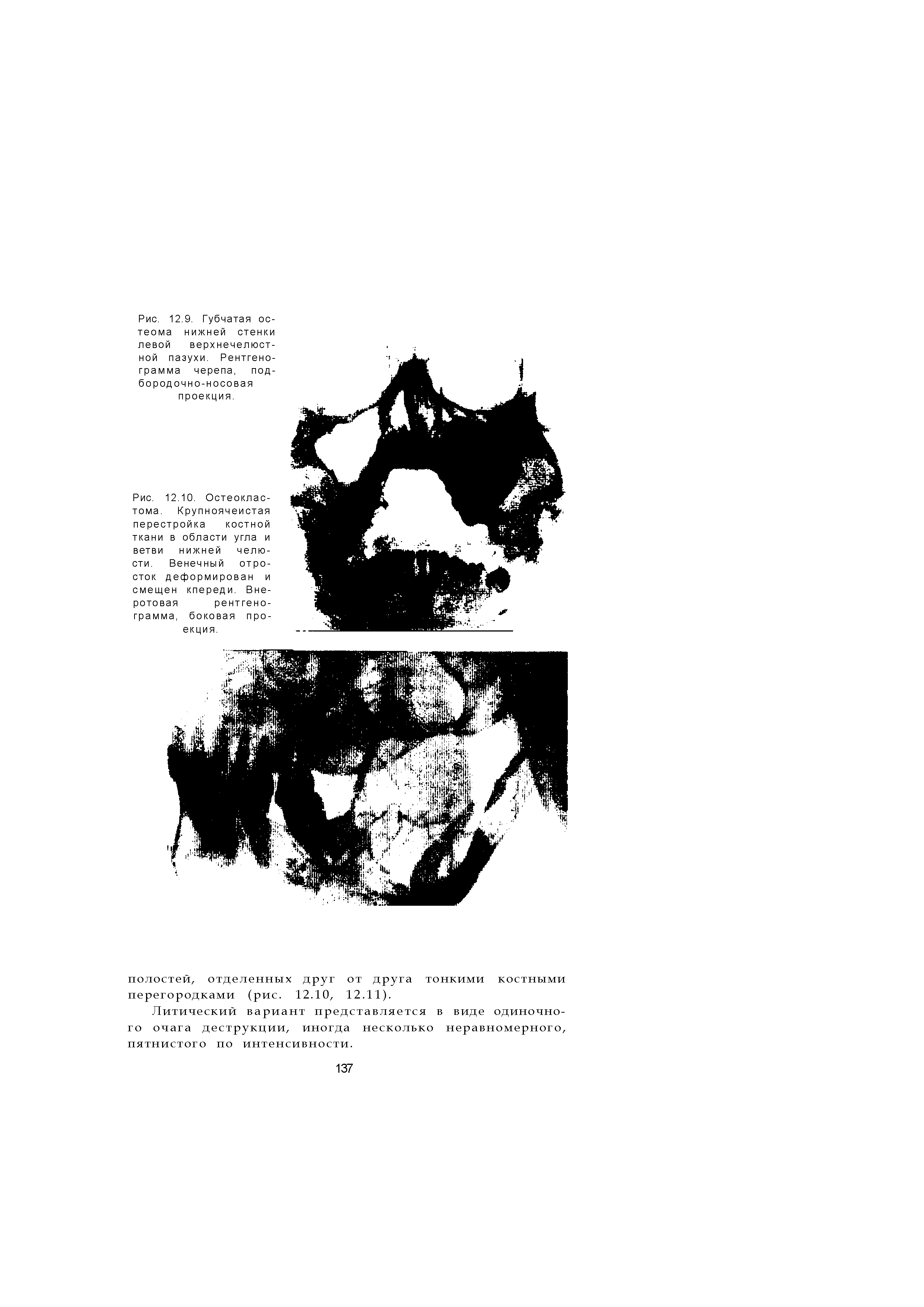 Рис. 12.10. Остеоклас-тома. Крупноячеистая перестройка костной ткани в области угла и ветви нижней челюсти. Венечный отросток деформирован и смещен кпереди. Вне-ротовая рентгено-...