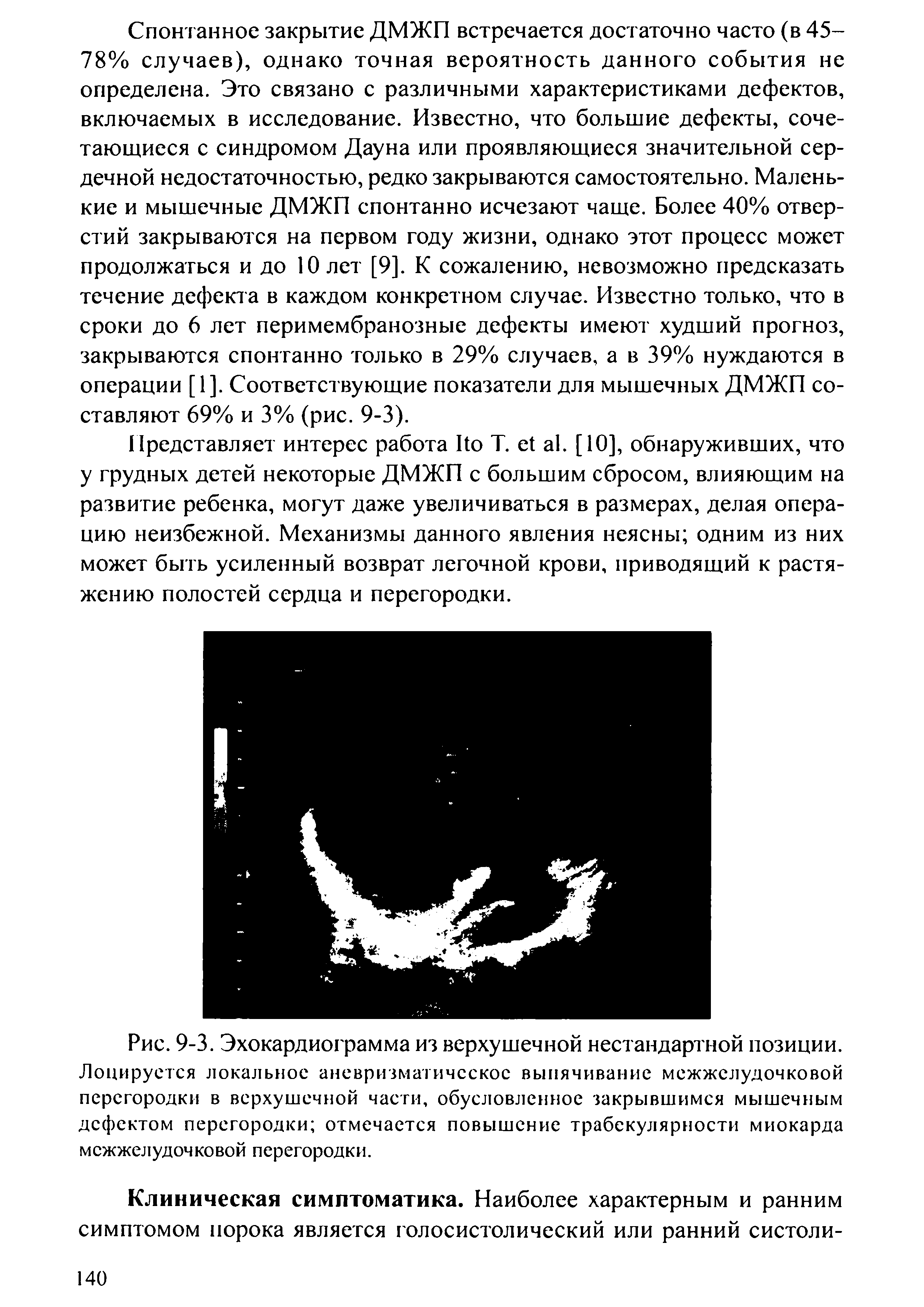 Рис. 9-3. Эхокардиограмма из верхушечной нестандартной позиции. Лоцируется локальное аневризматическое выпячивание межжелудочковой перегородки в верхушечной части, обусловленное закрывшимся мышечным дефектом перегородки отмечается повышение трабекулярности миокарда межжелудочковой перегородки.