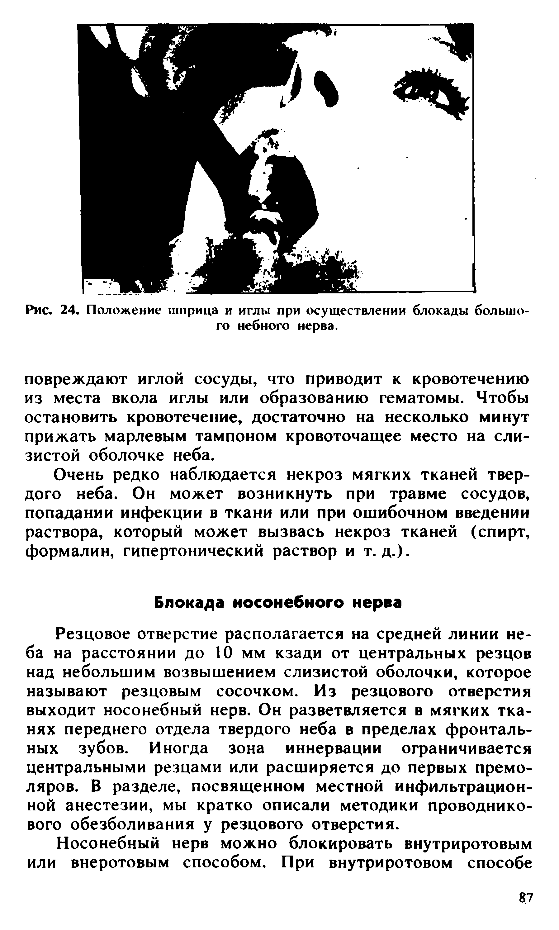 Рис. 24. Положение шприца и иглы при осуществлении блокады большого небного нерва.