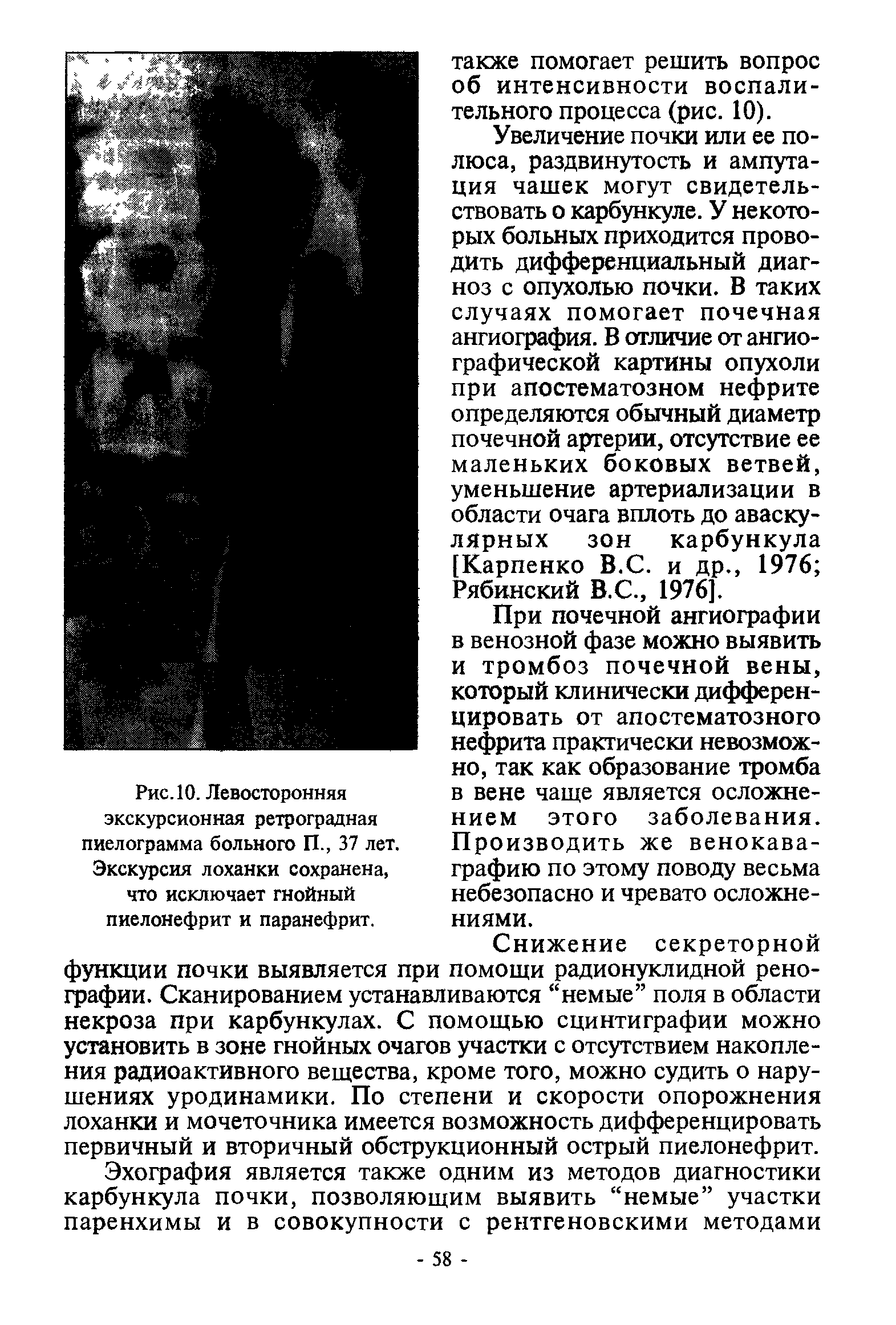 Рис. 10. Левосторонняя экскурсионная ретроградная пиелограмма больного П., 37 лет. Экскурсия лоханки сохранена, что исключает гнойный пиелонефрит и паранефрит.