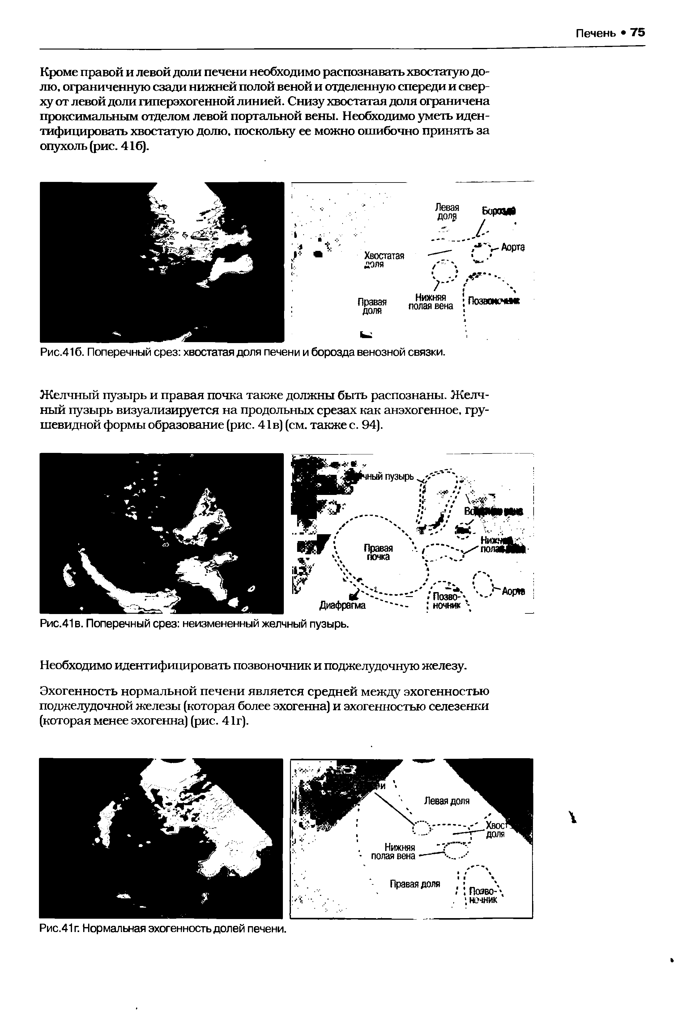 Рис.416. Поперечный срез хвостатая доля печени и борозда венозной связки.