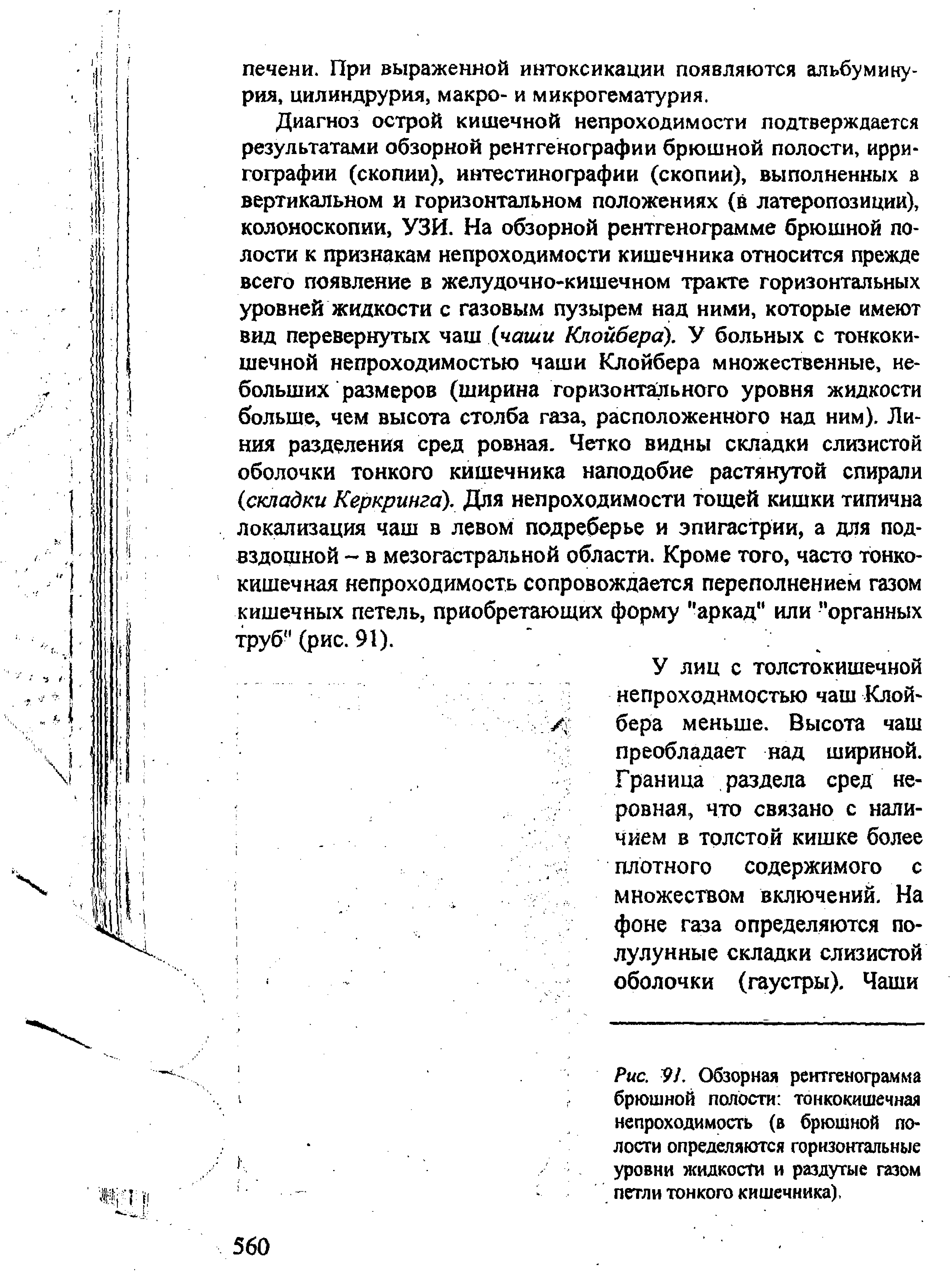 Рис. 97. Обзорная рентгенограмма брюшной полости тонкокишечная непроходимость (в брюшной полости определяются горизонтальные уровни жидкости и раздутые газом петли тонкого кишечника),...