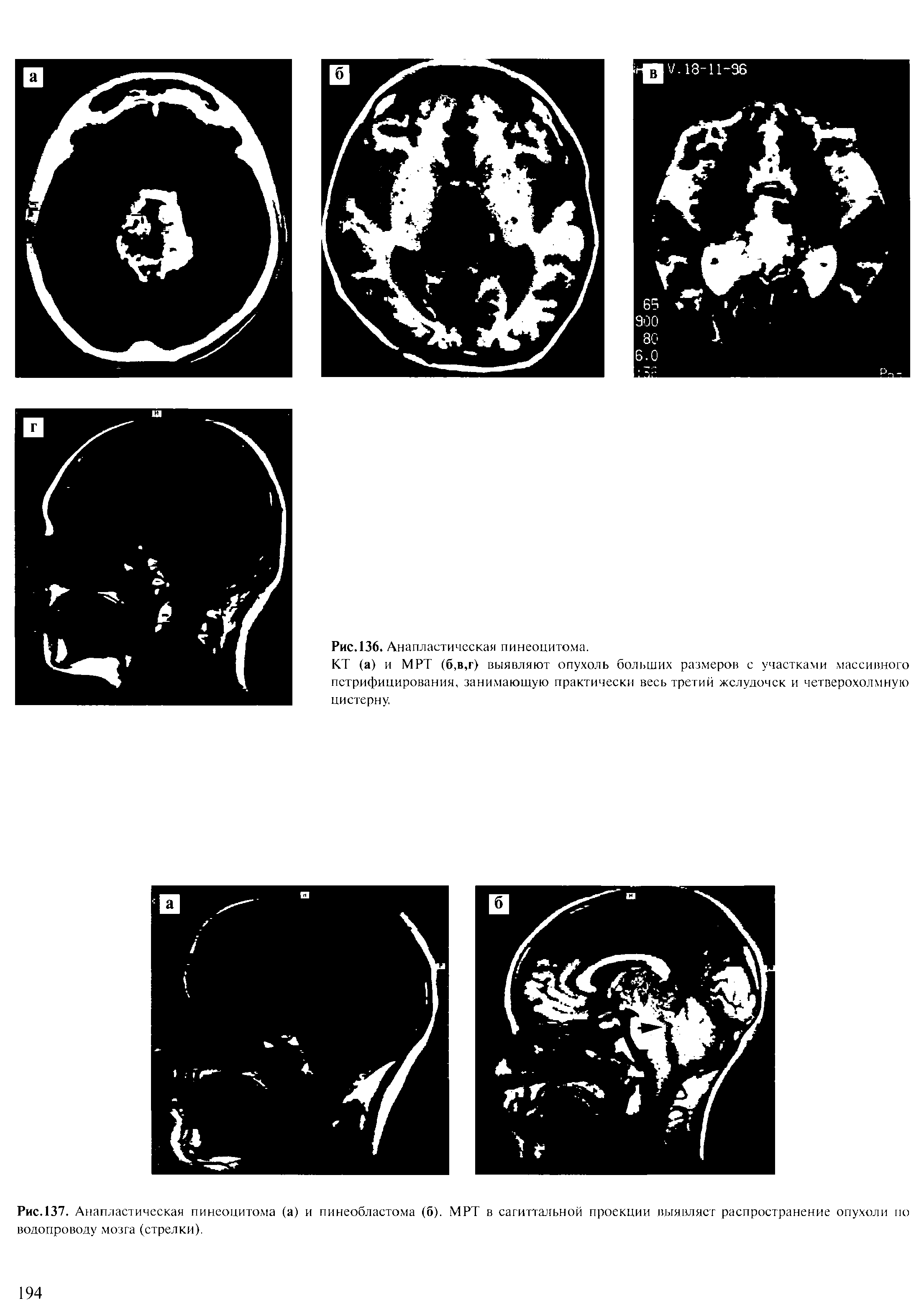 Рис.137. Анапластическая пинеоцитома (а) и пинеобластома (б). МРТ в сагиттальной проекции выявляет распространение опухоли по водопроводе мозга (стрелки).