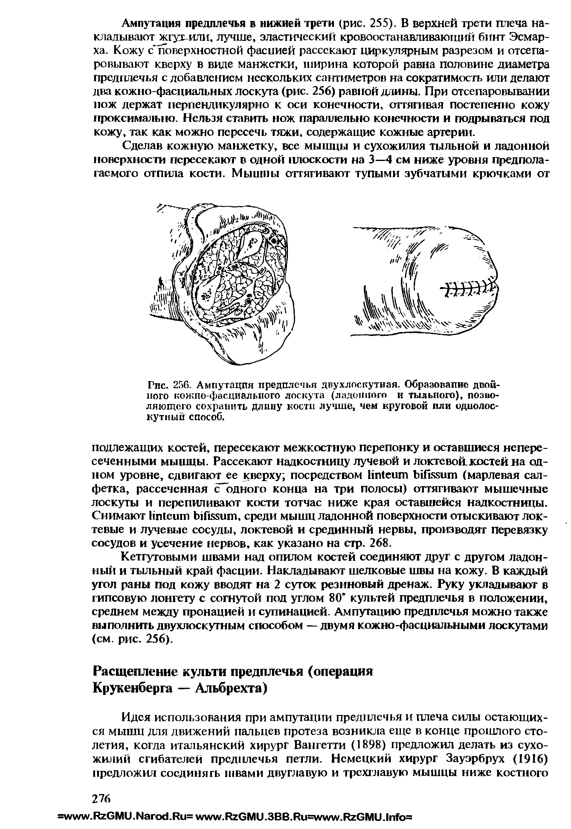 Рис. 256. Ампутация предплечья двухлоскутная. Образование двойного кожно-фасциалыгого лоскута (ладонного и тыльного), позволяющего сохранить длину кости лучше, чем круговой пли однолос-кутный способ.