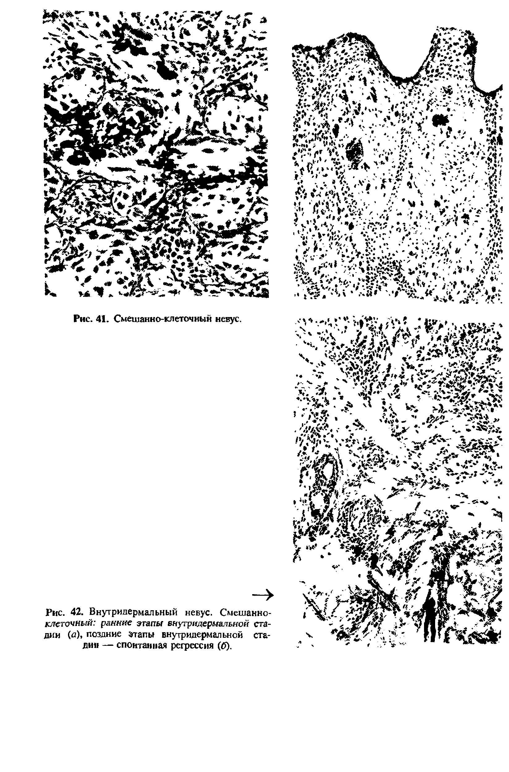 Рис. 42. Внутридермальный невус. Смешанно-клеточный ранние этапы внутридермальной стадии (п), поздние этапы внутридермальной стадии — спонтанная регрессия (б).