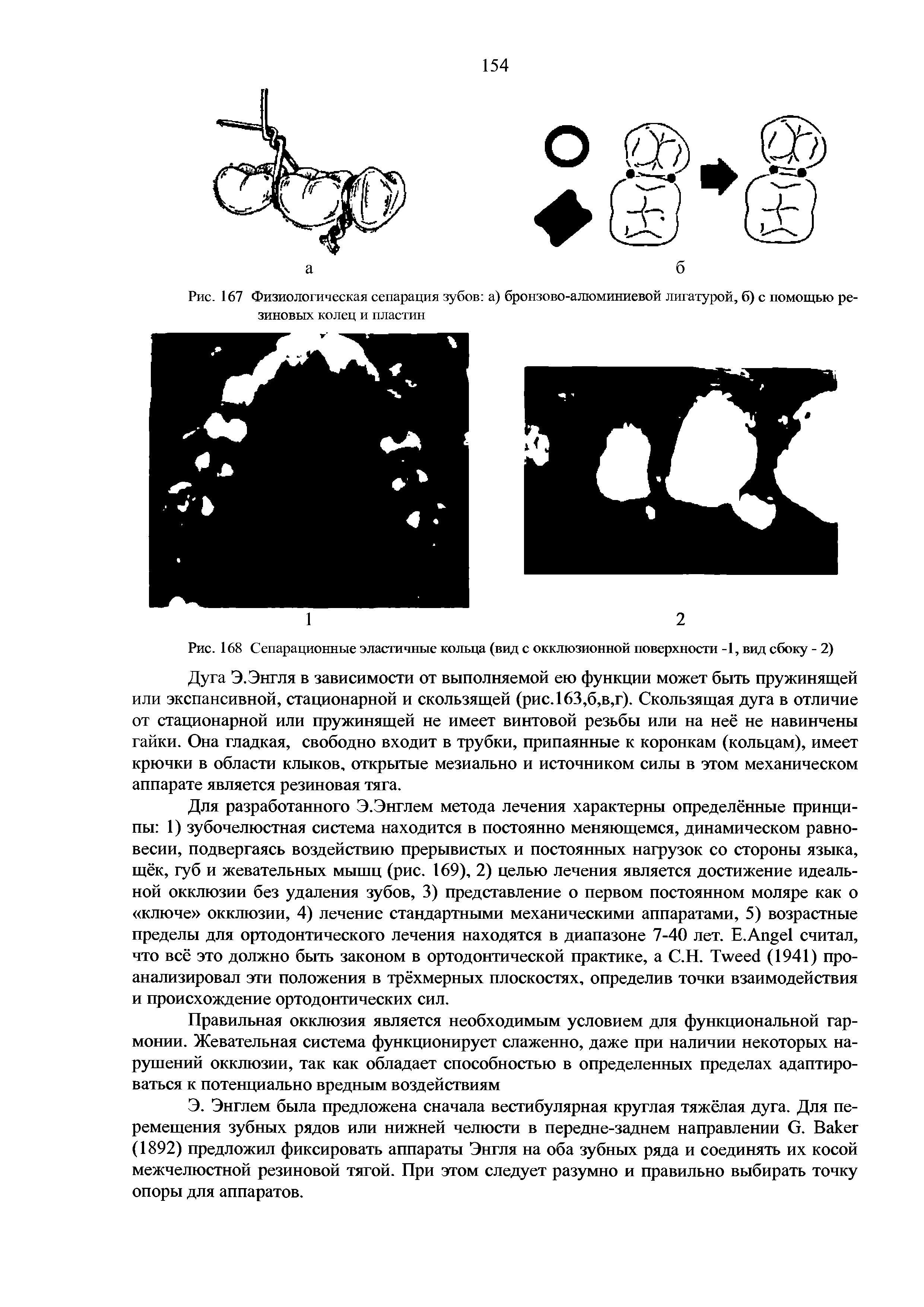 Рис. 167 Физиологическая сепарация зубов а) бронзово-алюминиевой лигатурой, б) с помощью ре-...