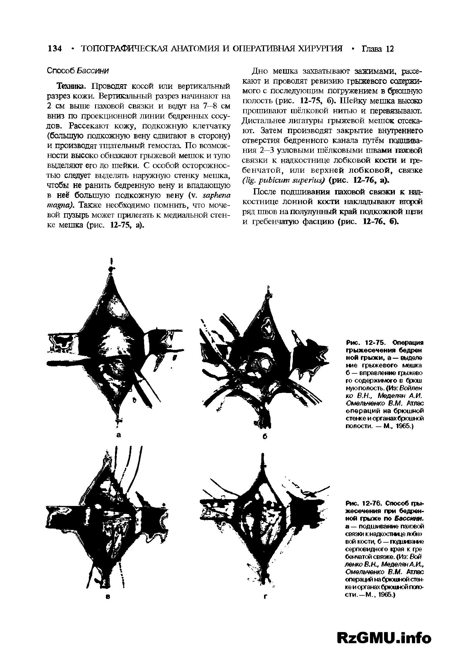 Рис. 12-76. Способ грыжесечения при бедренной грыже по бассит. а — подшивание паховой связки к надкостнице лобко вой кости, б — подливание серповидного края к гре бенчатой связке. (Из Вой ленкоВ.Н., Меделян А. И., Омельченко В.М. Аглес операций на брюшной стенке и органах брюшной полости.—М., 1965.)...