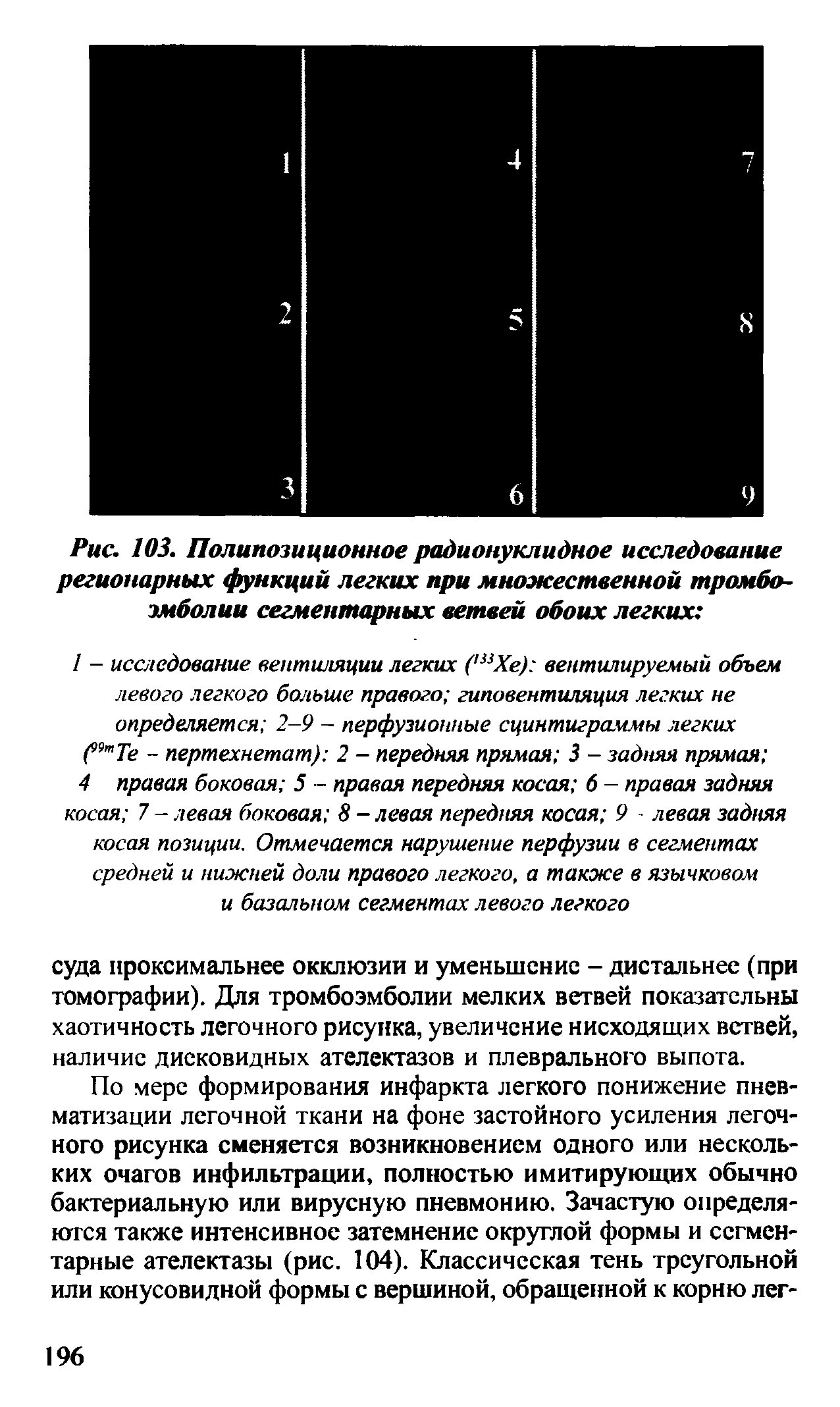 Рис. 103. Полипозиционное радионуклидное исследование регионарных функций легких при множественной тромбоэмболии сегментарных ветвей обоих легких ...