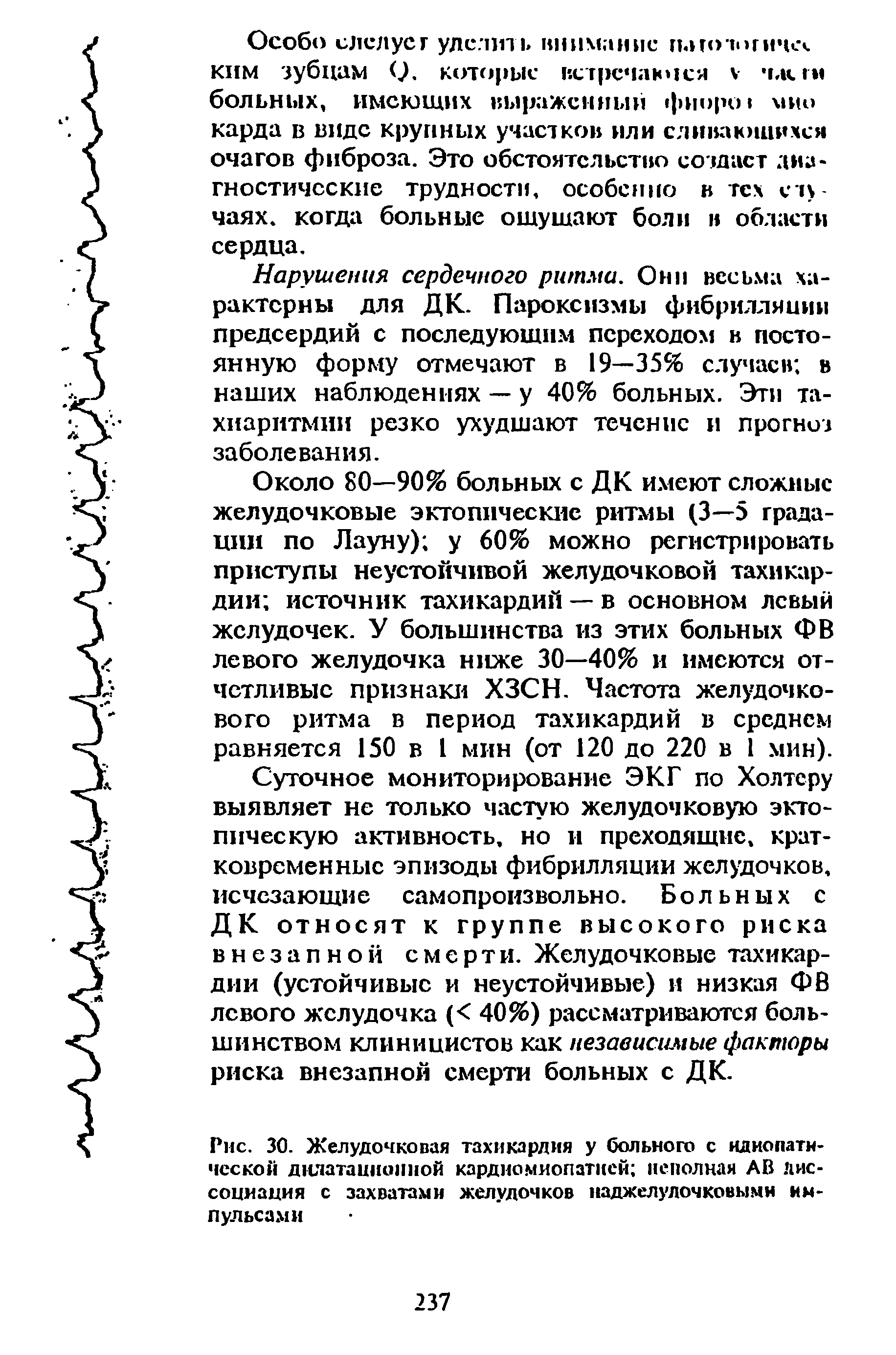 Рис. 30. Желудочковая тахикардия у больного с идиопатической дюатаннопной кардиомиопатией неполная АВ диссоциация с захватами желудочков наджелудочковыми импульсами...