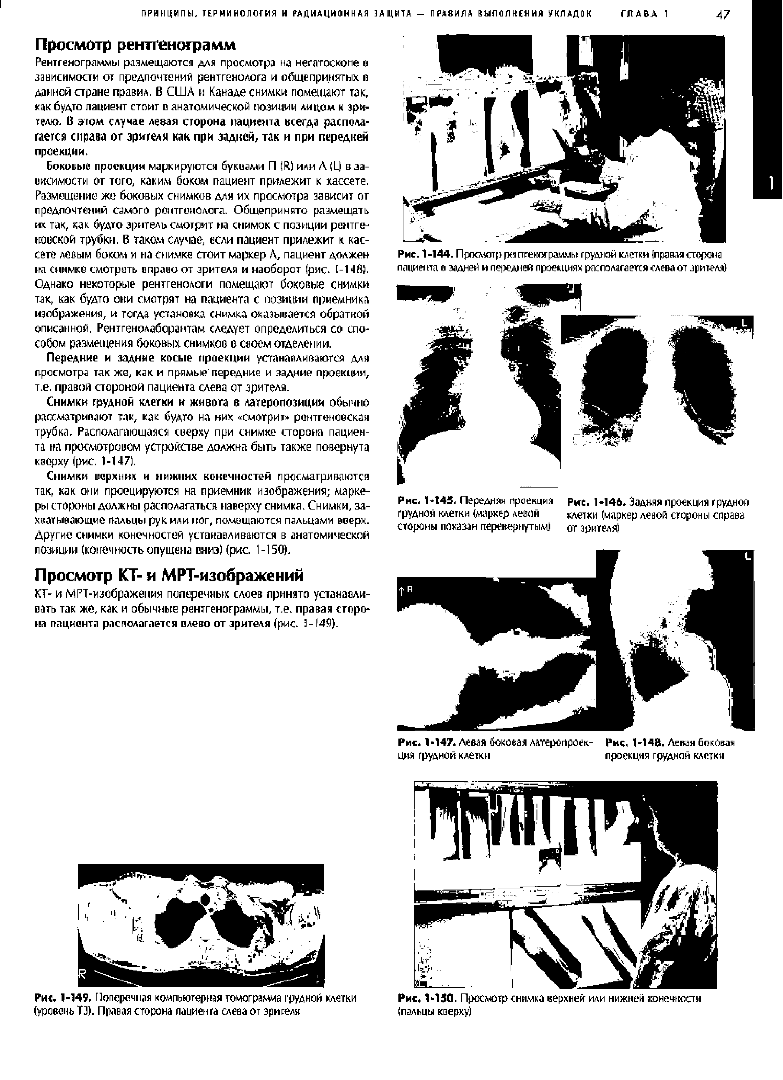 Рис. 1-149, Поперечная компьютерная томограмма грудной клетки (уровень Т1). Правая сторона пациента слева от зрителя...