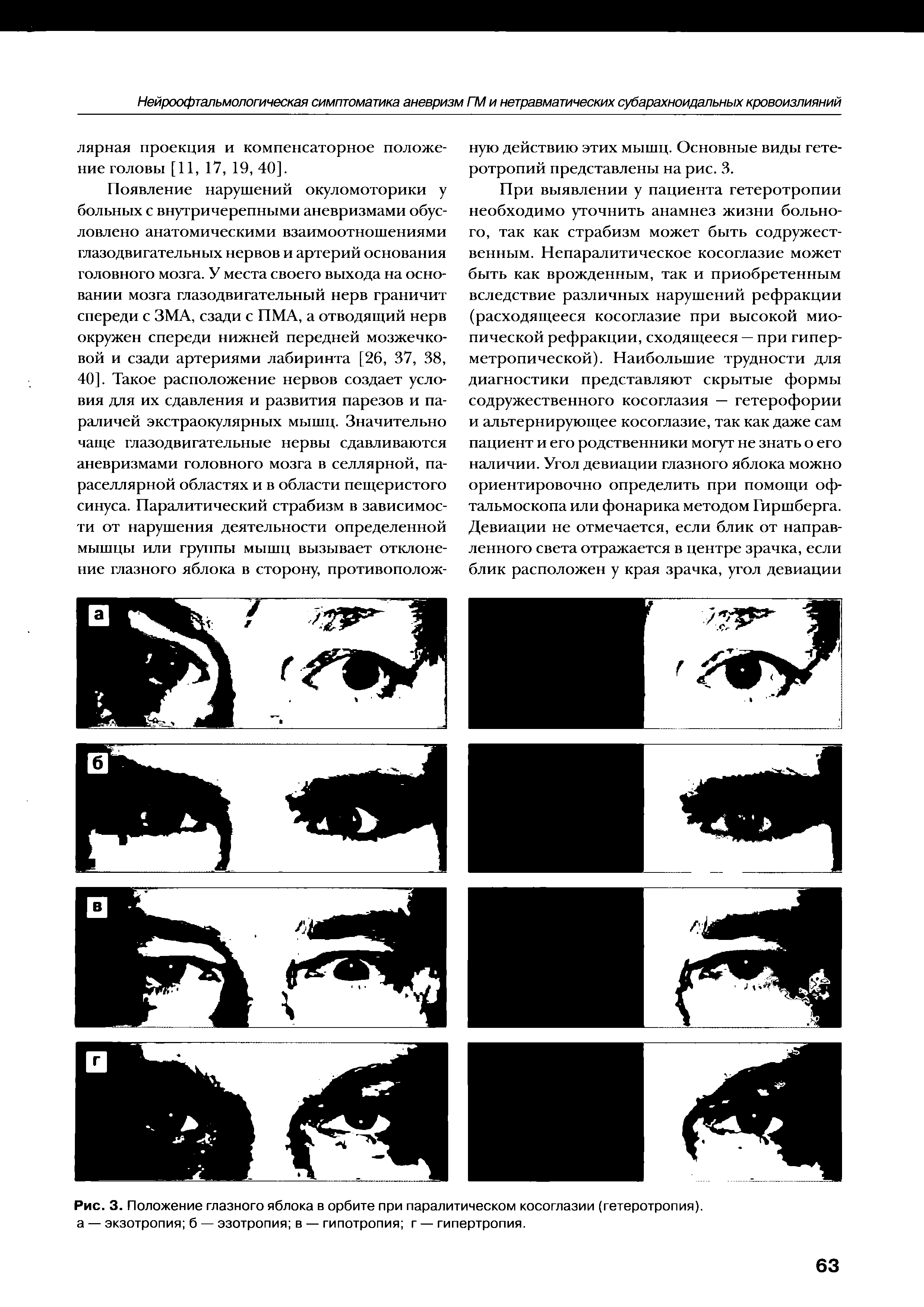 Рис. 3. Положение глазного яблока в орбите при паралитическом косоглазии (гетеротропия). а — экзотропия б — эзотропия в — гипотропия г — гипертропия.