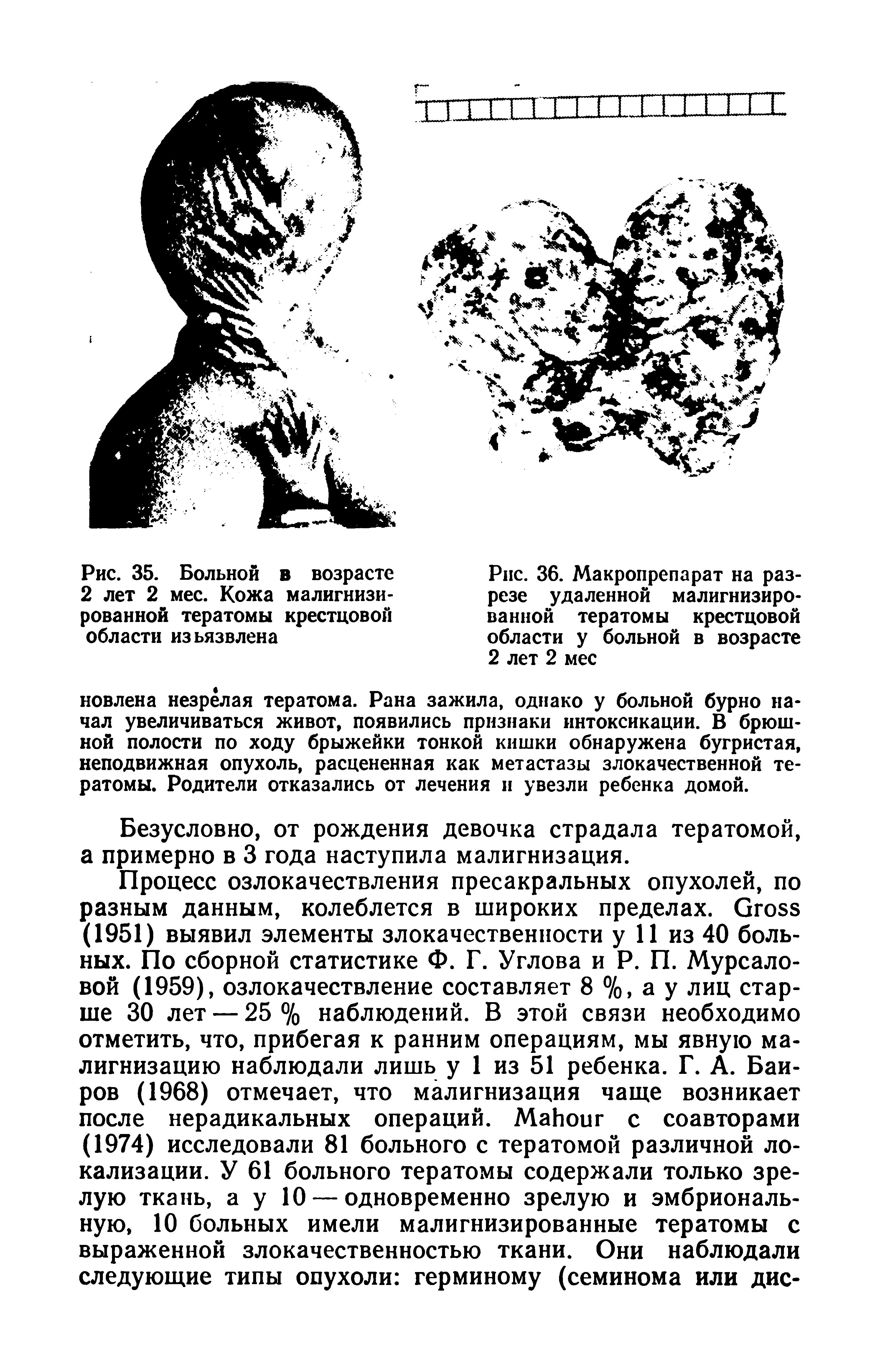 Рис. 36. Макропрепарат на разрезе удаленной малигнизированной тератомы крестцовой области у больной в возрасте 2 лет 2 мес...