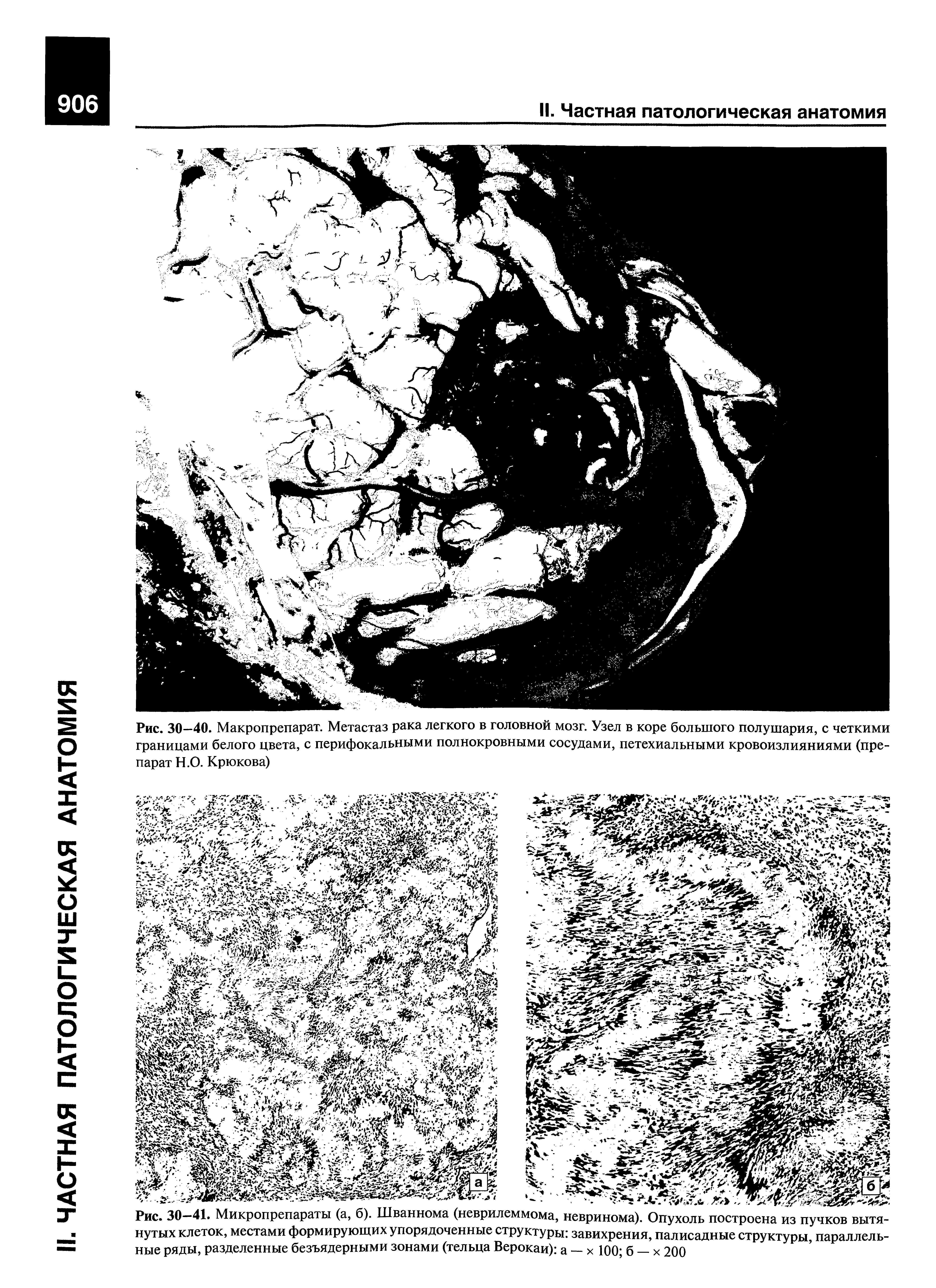 Рис. 30—40. Макропрепарат. Метастаз рака легкого в головной мозг. Узел в коре большого полушария, с четкими границами белого цвета, с перифокальными полнокровными сосудами, петехиальными кровоизлияниями (препарат Н.О. Крюкова)...