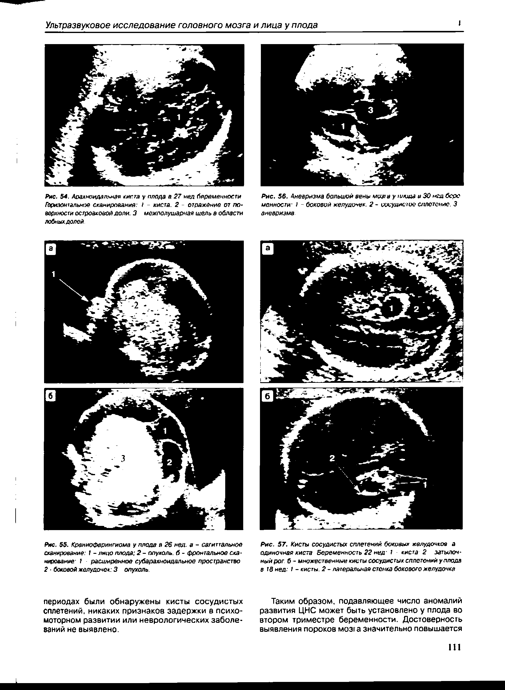 Рис. 57. Кисты сосудистых сплетений боковых желудочков а одиночная киста Беременность 22 над- 1 киста 2 затылочный рог б - множественные кисты сосудистых сплетений у плода в 13 нед - 1 - кисты. 2 - латеральная стенка бокового желудочка...