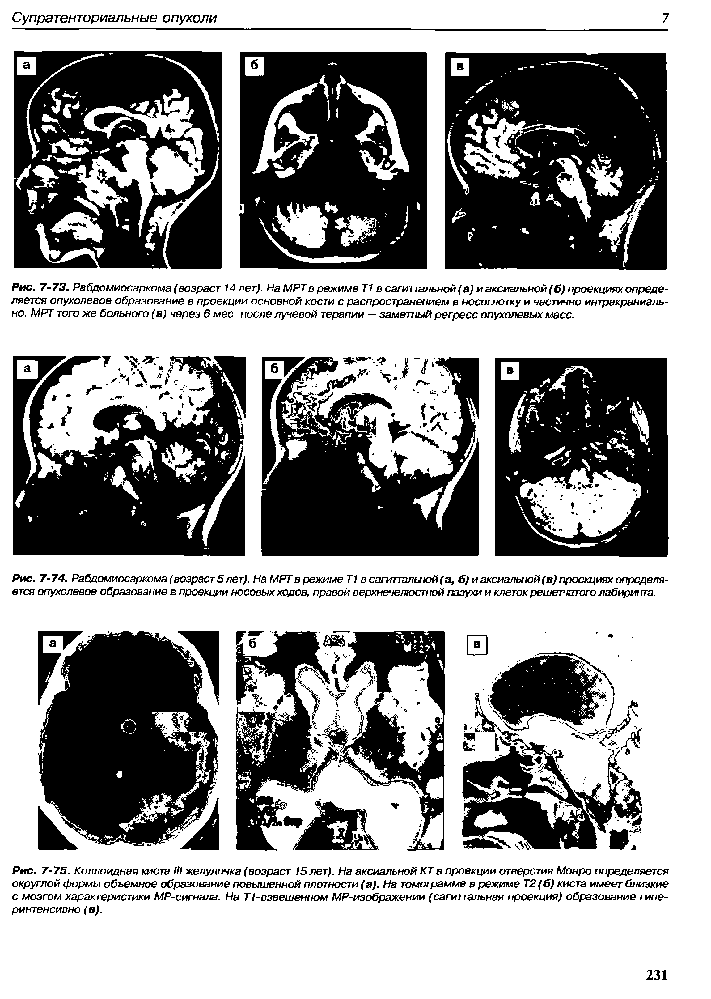 Рис. 7-75. Коллоидная киста III желудочка (возраст 15 лет). На аксиальной КТ в проекции отверстия Монро определяется округлой формы объемное образование повышенной плотности (а). На томограмме в режиме Т2 (б) киста имеет близкие с мозгом характеристики MP-сигнала. На Т1-взвешенном MP-изображении (сагиттальная проекция) образование гиперинтенсивно (в).