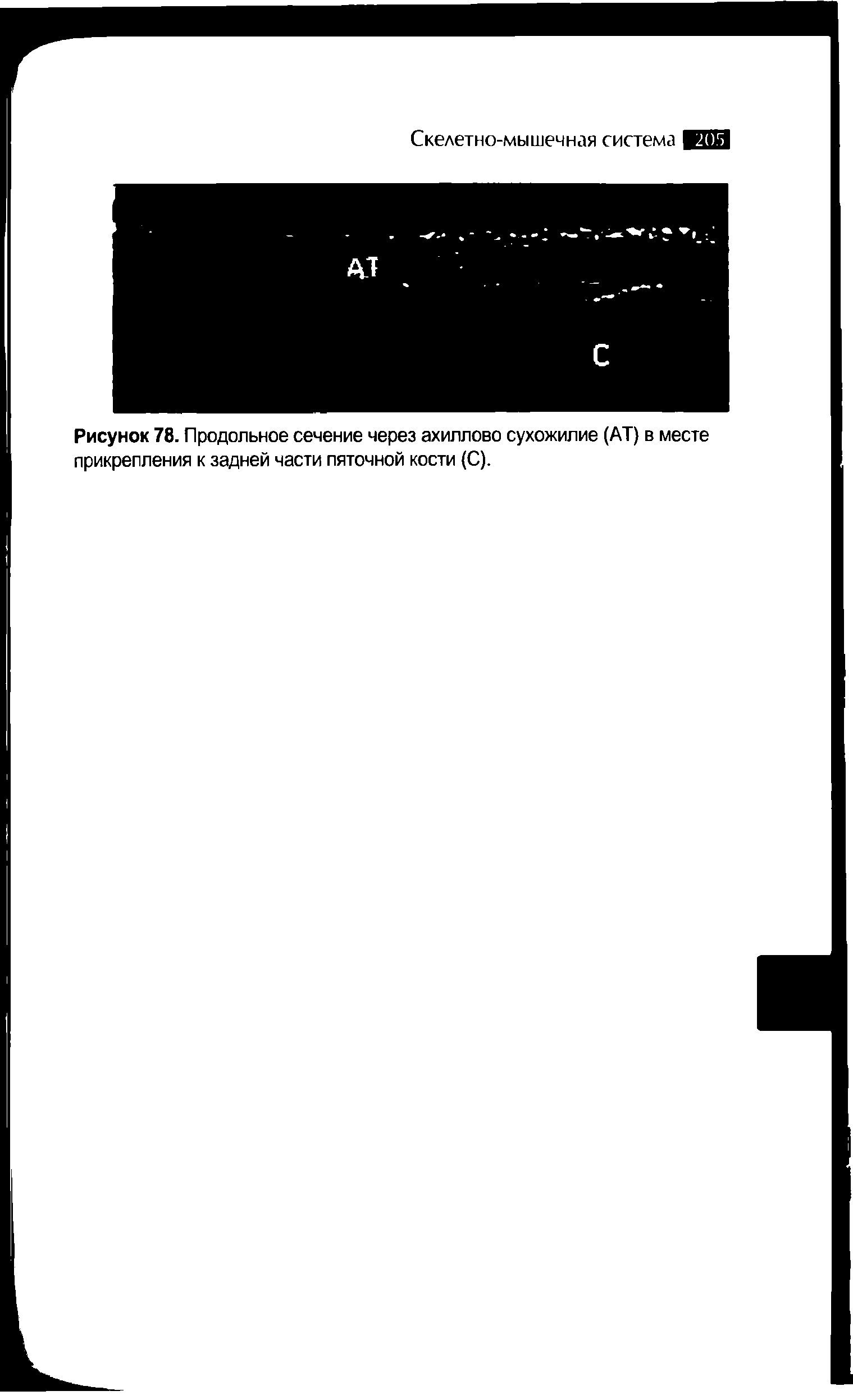Рисунок 78. Продольное сечение через ахиллово сухожилие (АТ) в месте прикрепления к задней части пяточной кости (С).