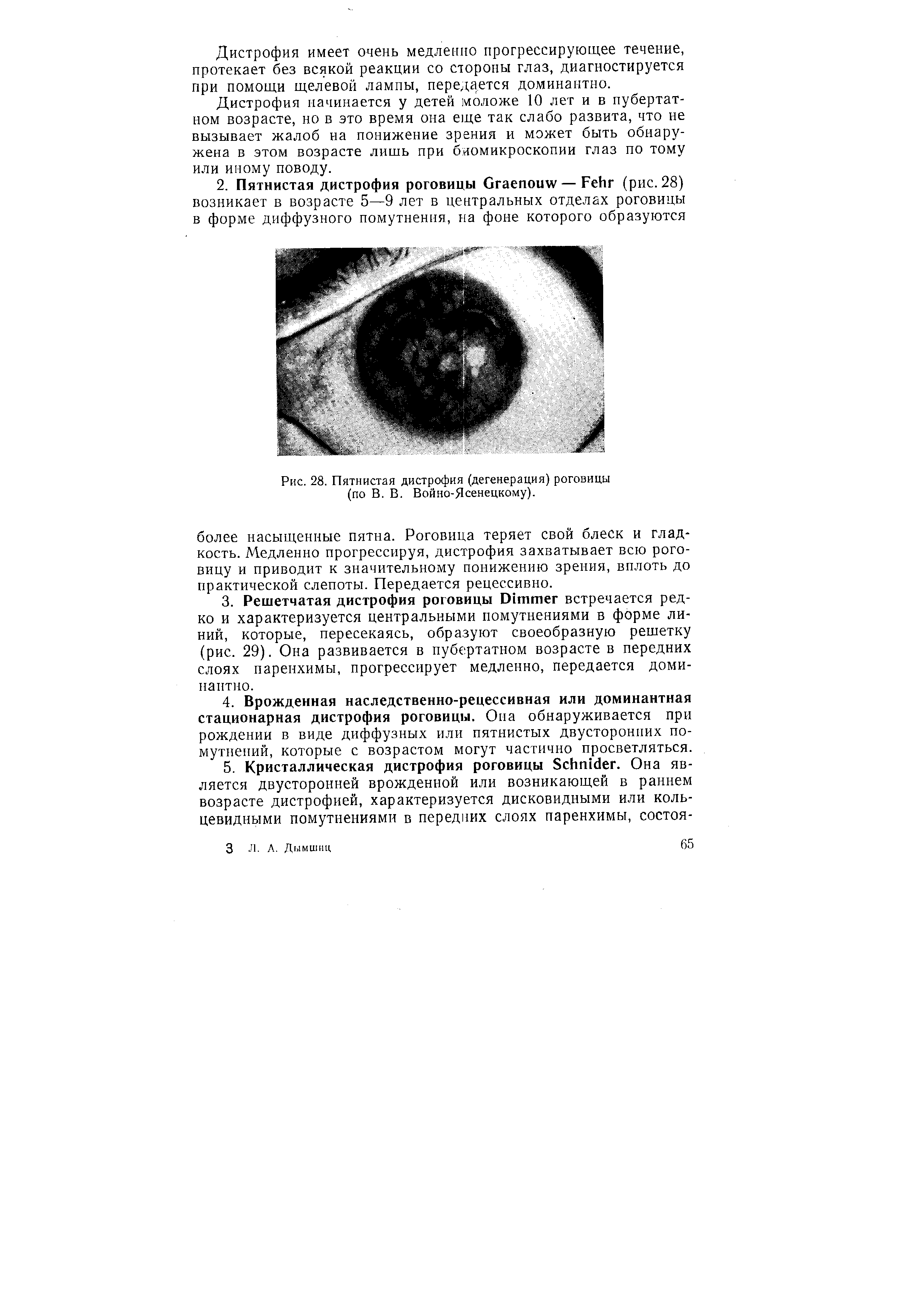 Рис. 28. Пятнистая дистрофия (дегенерация) роговицы (по В. В. Войно-Ясенецкому).