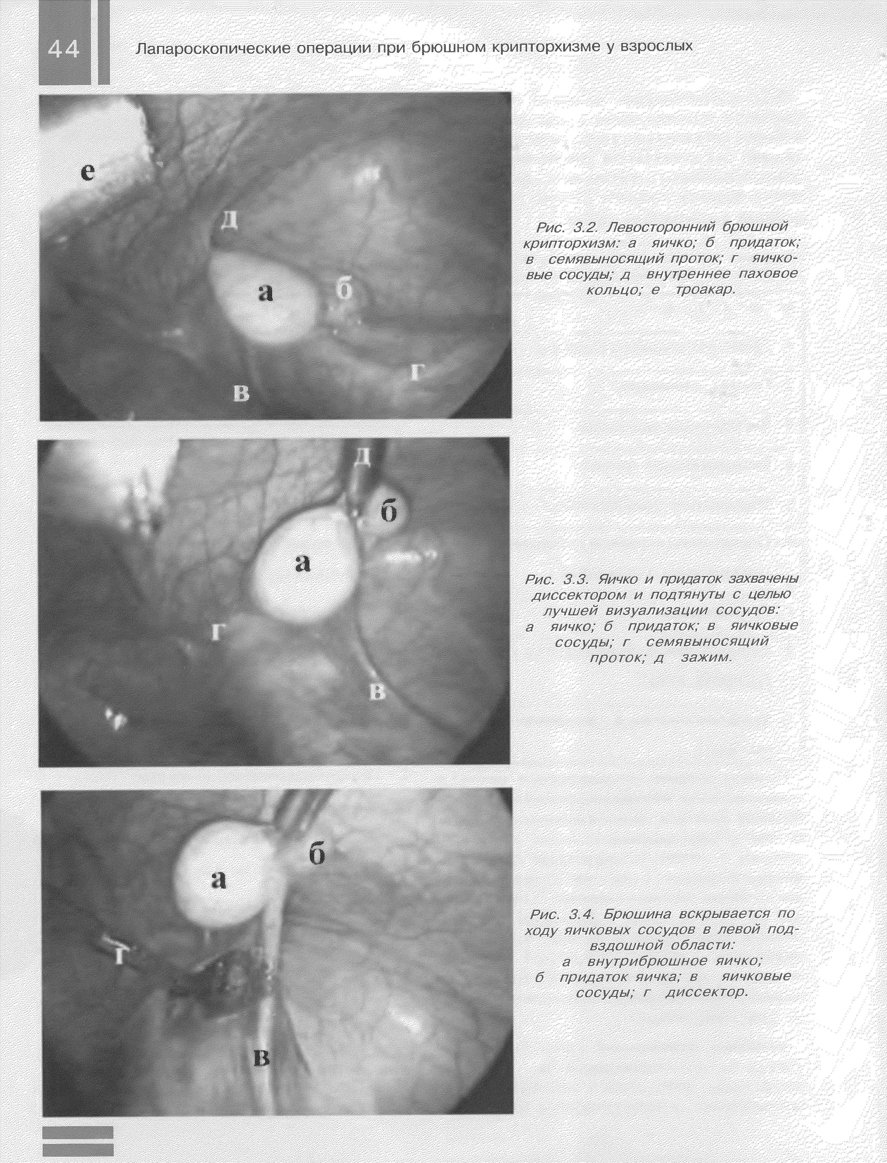 Рис. 3.3. Яичко и придаток захвачены диссектором и подтянуты с целью лучшей визуализации сосудов а яичко б придаток в яичковые сосуды г семявыносящий проток д зажим.
