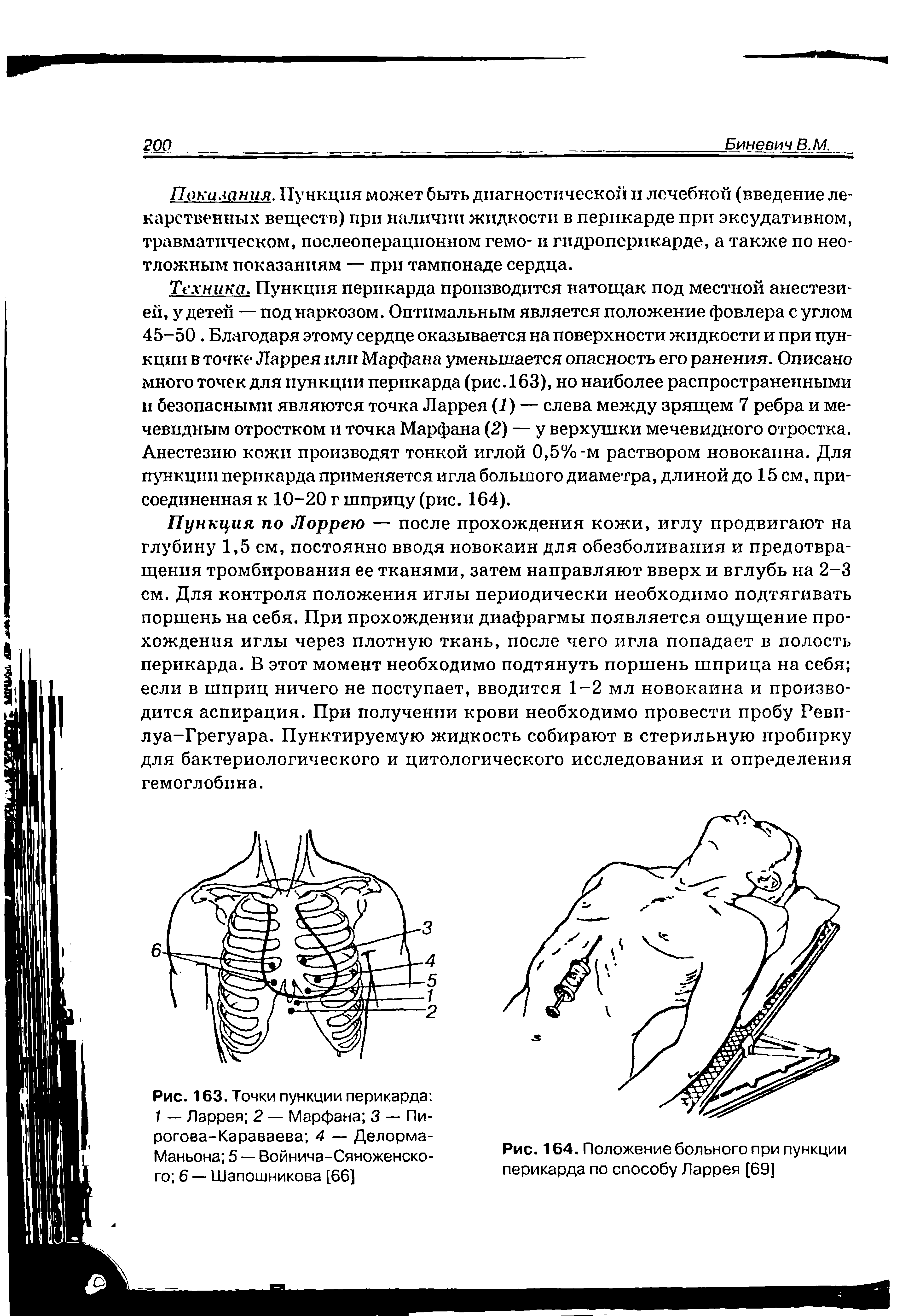 Рис. 164. Положение больного при пункции перикарда по способу Ларрея [69]...