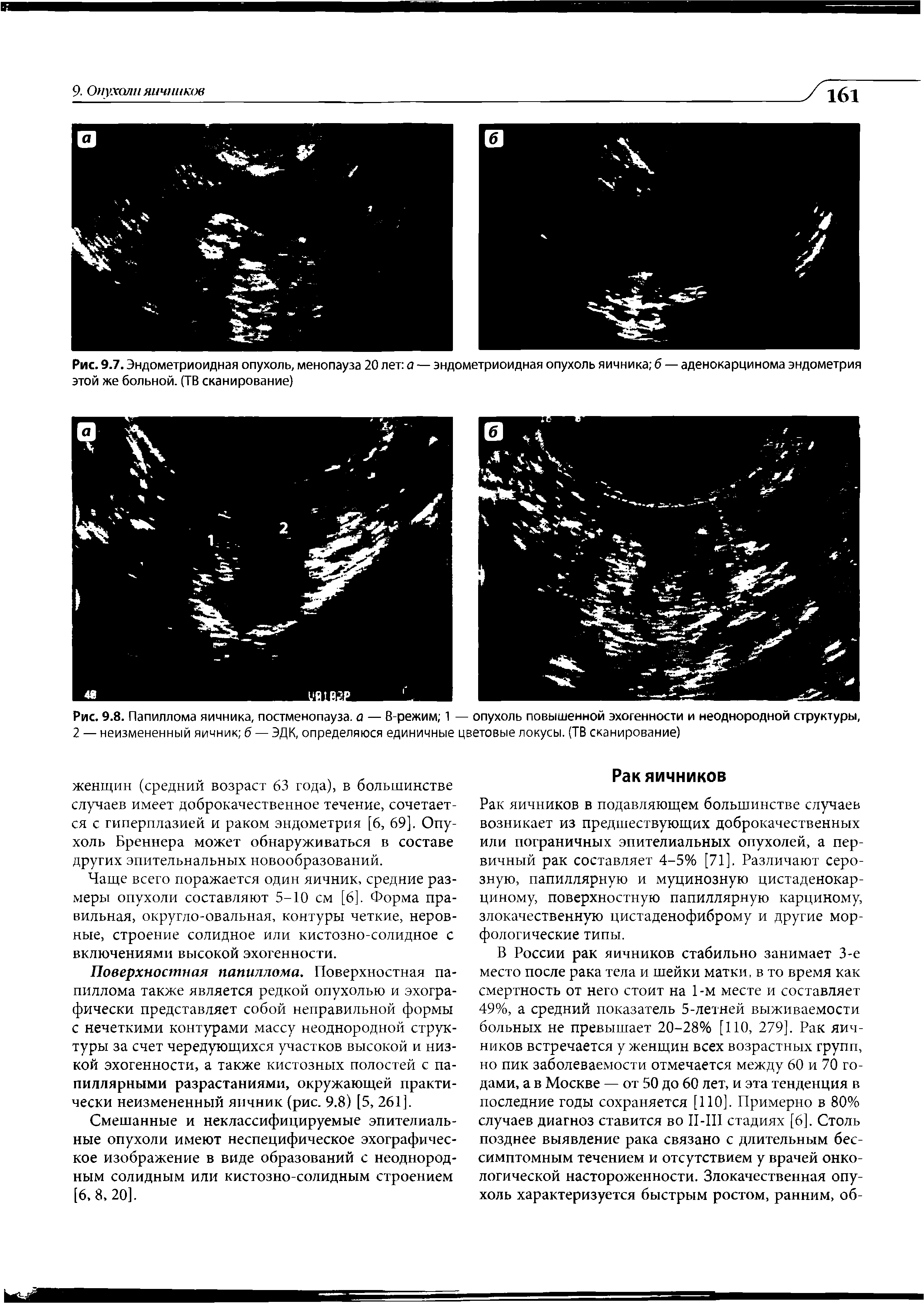Рис. 9.8. Папиллома яичника, постменопауза, а — В-режим 1 — опухоль повышенной эхогенности и неоднородной структуры,...