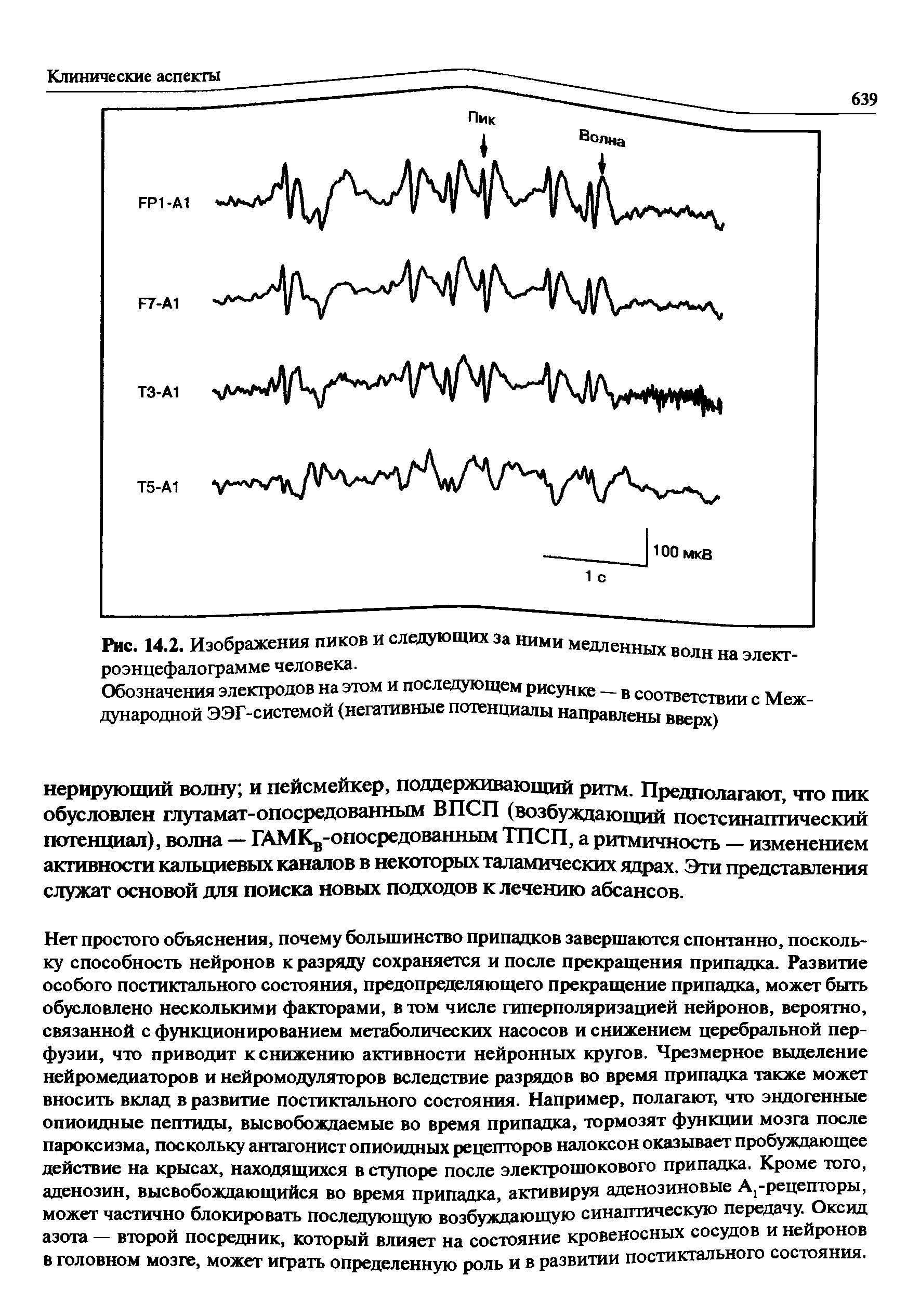 Рис. 14.2. Изображения пиков и следующих за ними медленных волн на электроэнцефалограмме человека.