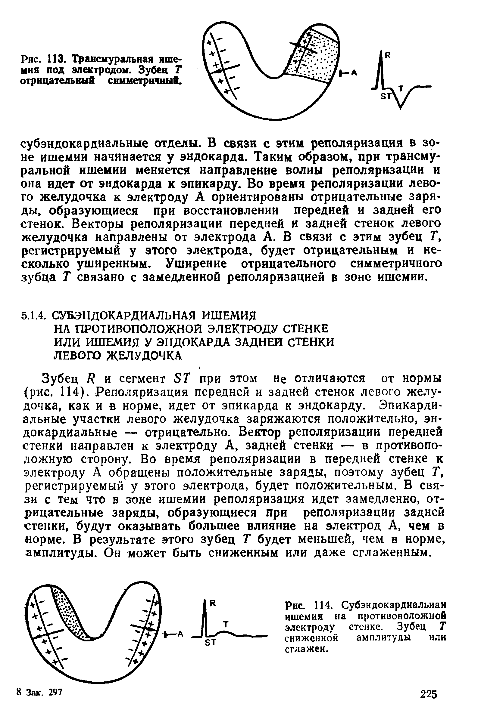 Рис. 114. Субэндокардиальная ишемия на противоположной электроду стенке. Зубец Т сниженной амплитуды или сглажен.