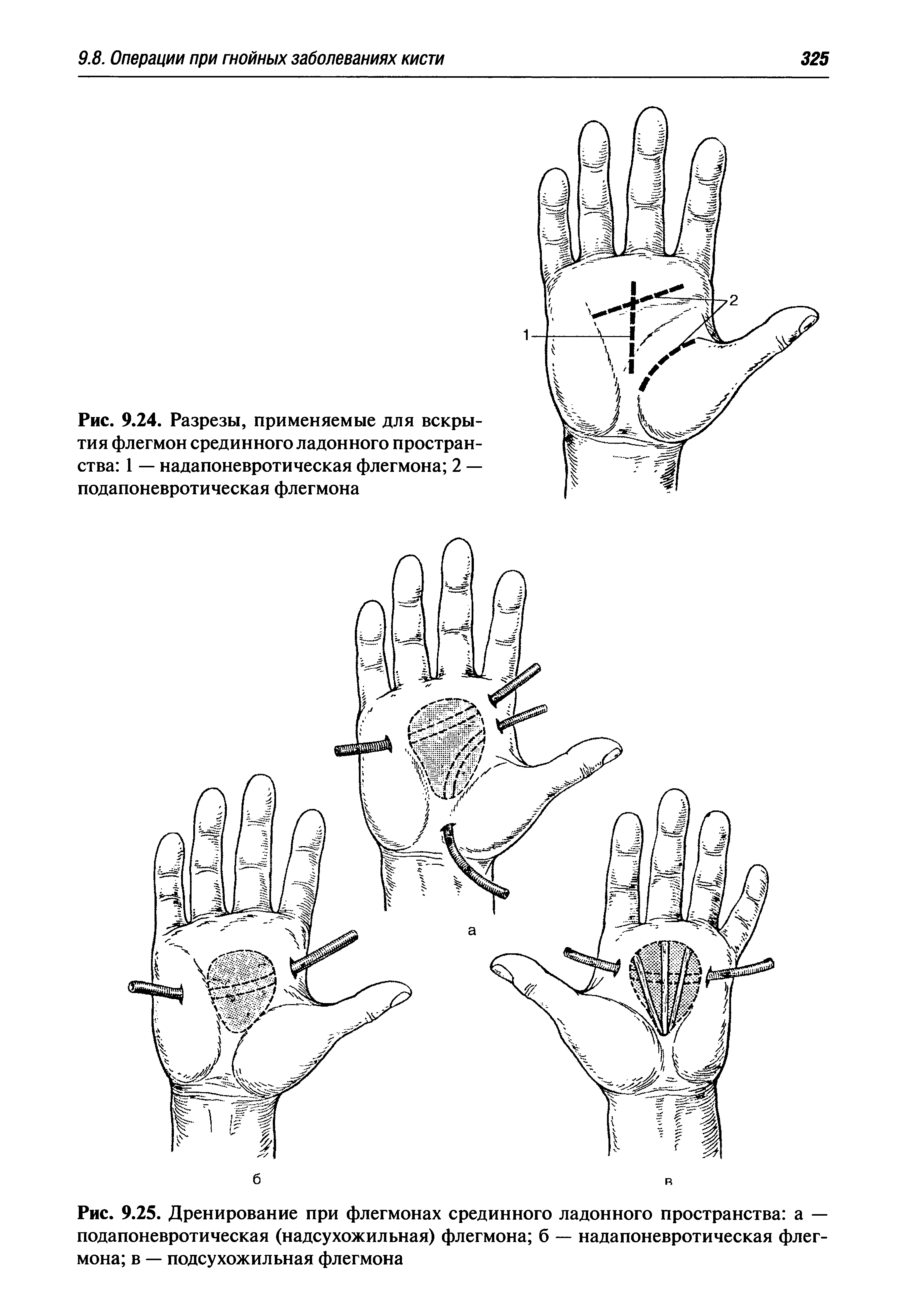 Рис. 9.25. Дренирование при флегмонах срединного ладонного пространства а — подапоневротическая (надсухожильная) флегмона б — надапоневротическая флегмона в — подсухожильная флегмона...
