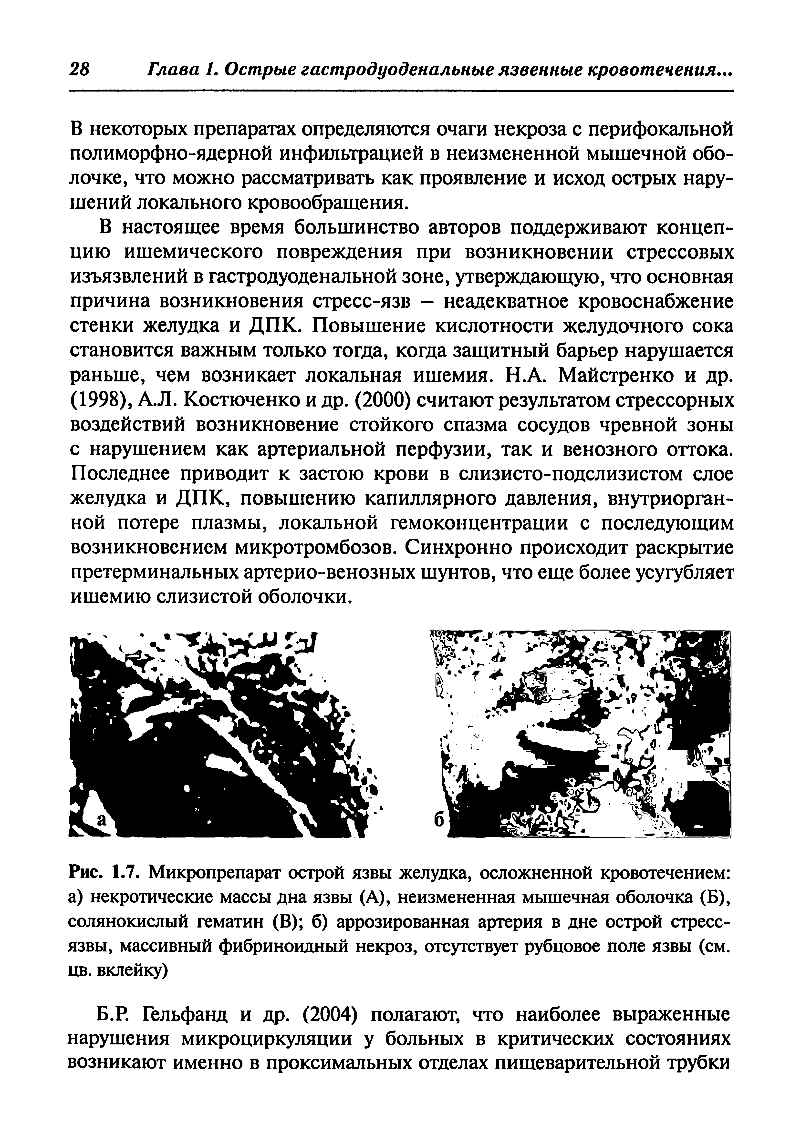 Рис. 1.7. Микропрепарат острой язвы желудка, осложненной кровотечением а) некротические массы дна язвы (А), неизмененная мышечная оболочка (Б), солянокислый гематин (В) б) аррозированная артерия в дне острой стресс-язвы, массивный фибриноидный некроз, отсутствует рубцовое поле язвы (см. цв. вклейку)...