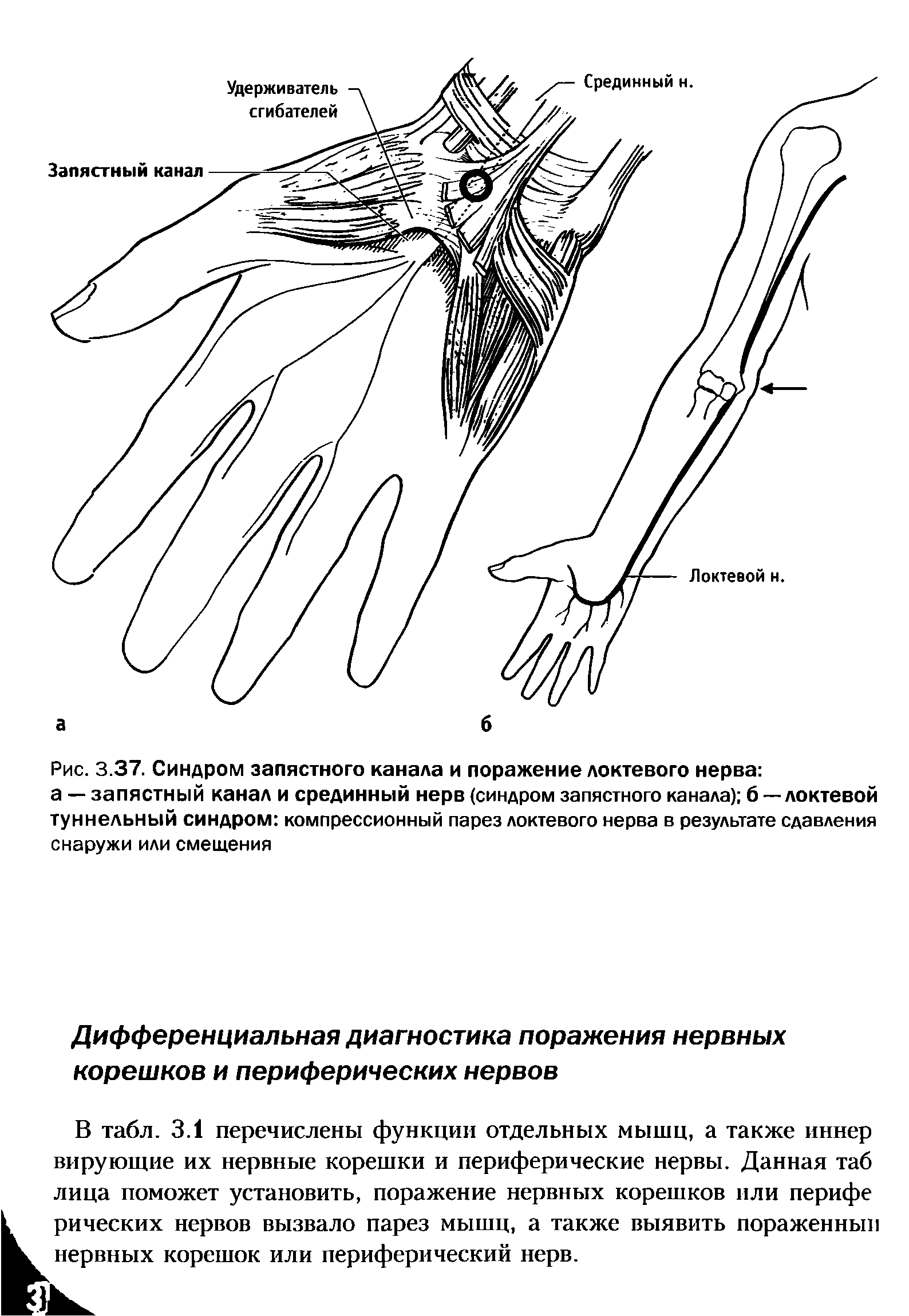 Рис. 3.37. Синдром запястного канала и поражение локтевого нерва а — запястный канал и срединный нерв (синдром запястного канала) б — локтевой туннельный синдром компрессионный парез локтевого нерва в результате сдавления снаружи или смещения...