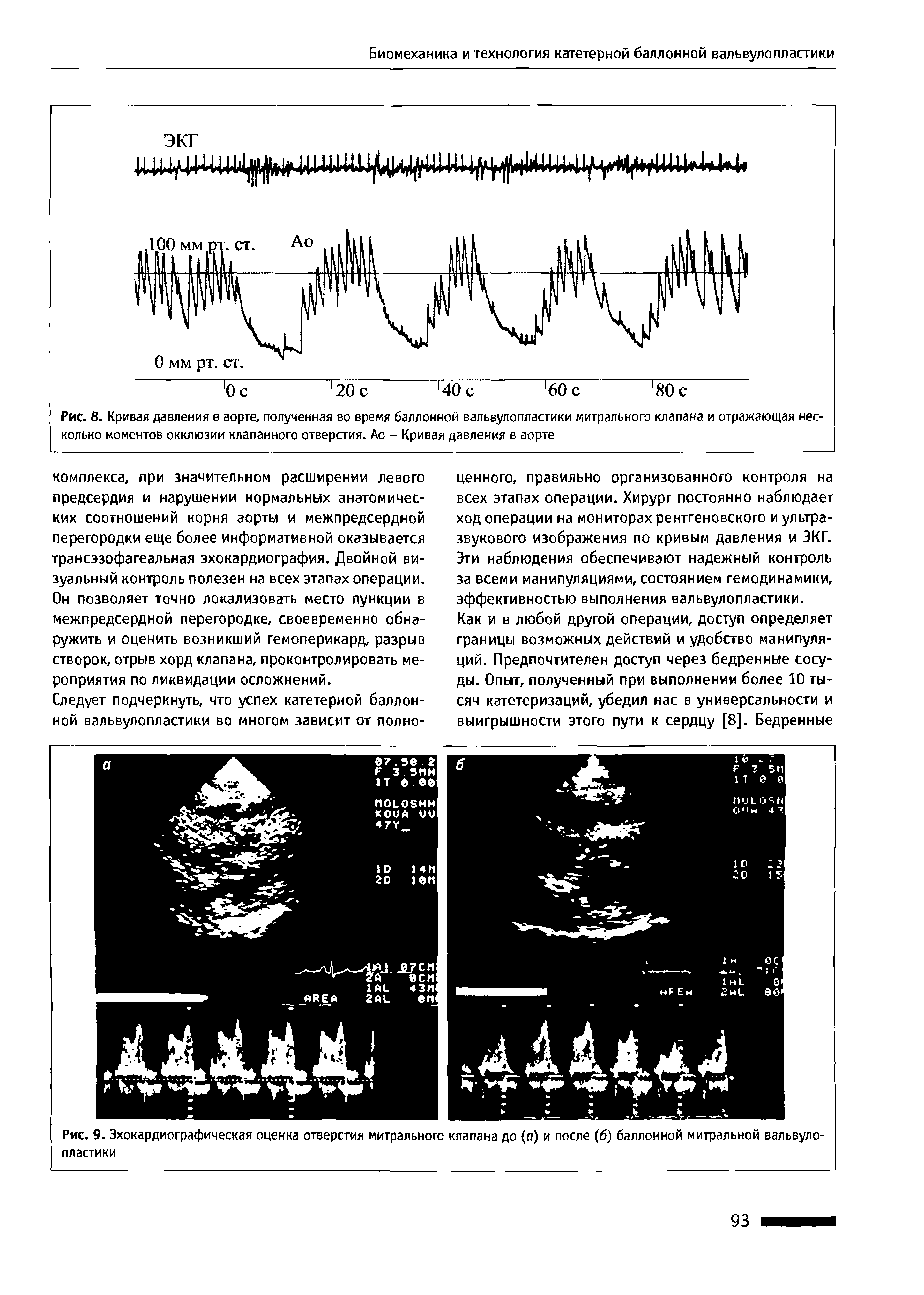Рис. 9. Эхокардиографическая оценка отверстия митрального клапана до (о) и после (б) баллонной митральной вальвулопластики...