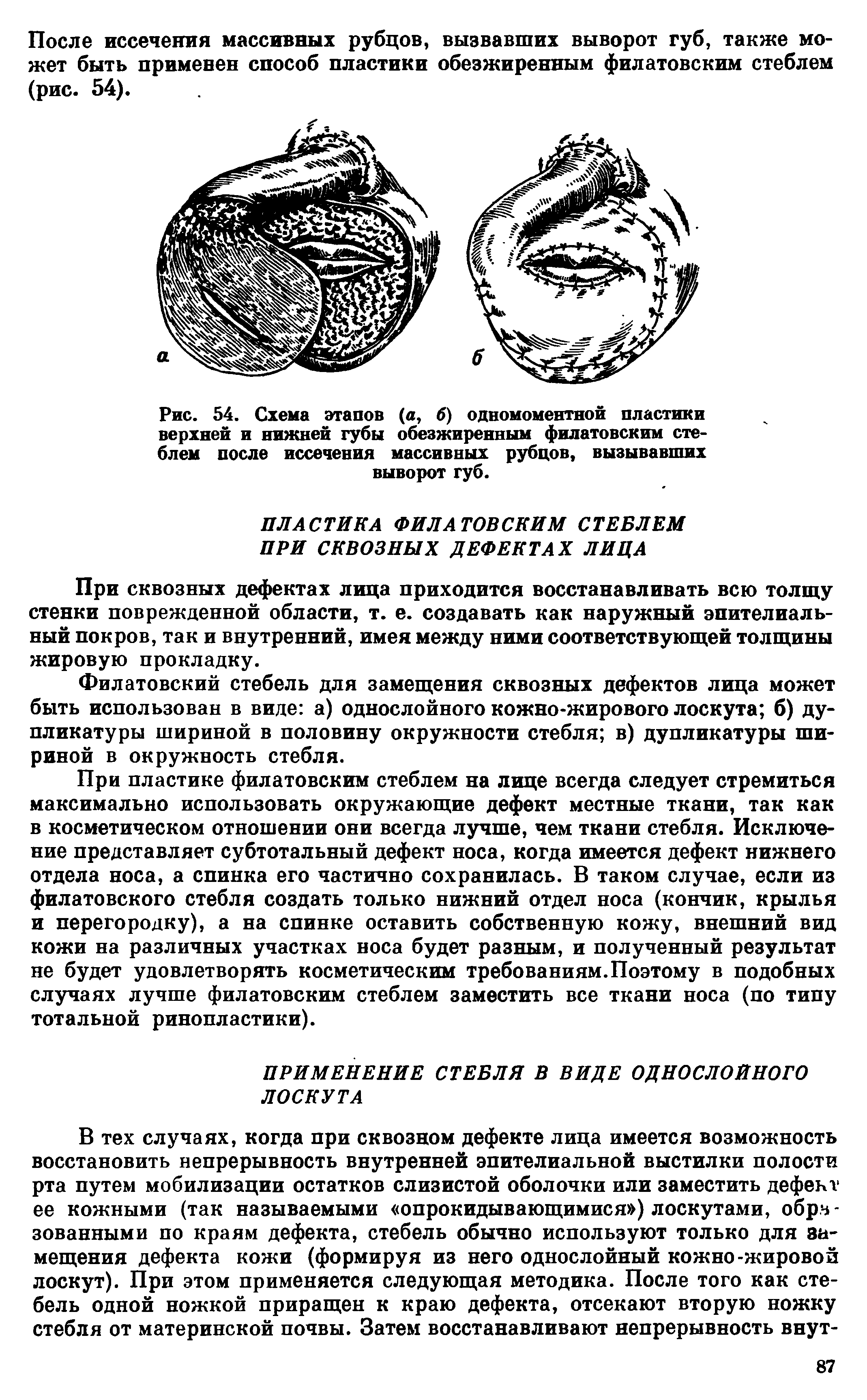 Рис. 54. Схема этапов (а, б) одномоментной пластики верхней и нижней губы обезжиренным филатовским стеблем после иссечения массивных рубцов, вызывавших выворот губ.