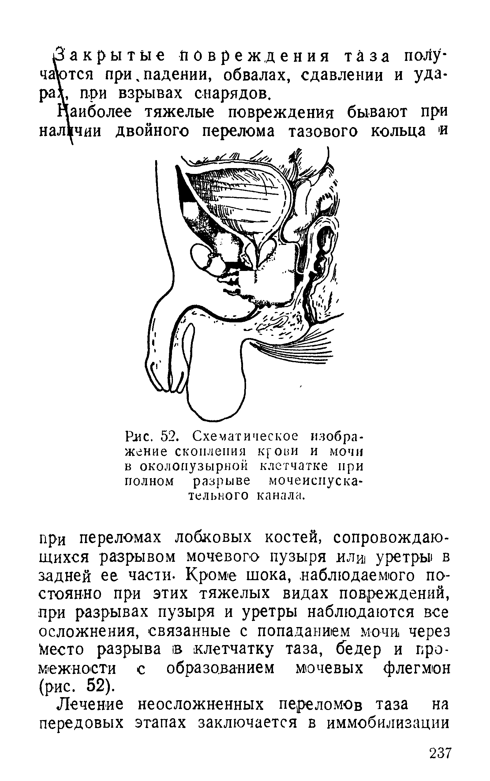 Рис. 52. Схематическое изображение скопления крови и мочи в околопузырной клетчатке при полном разрыве мочеиспускательного канала.