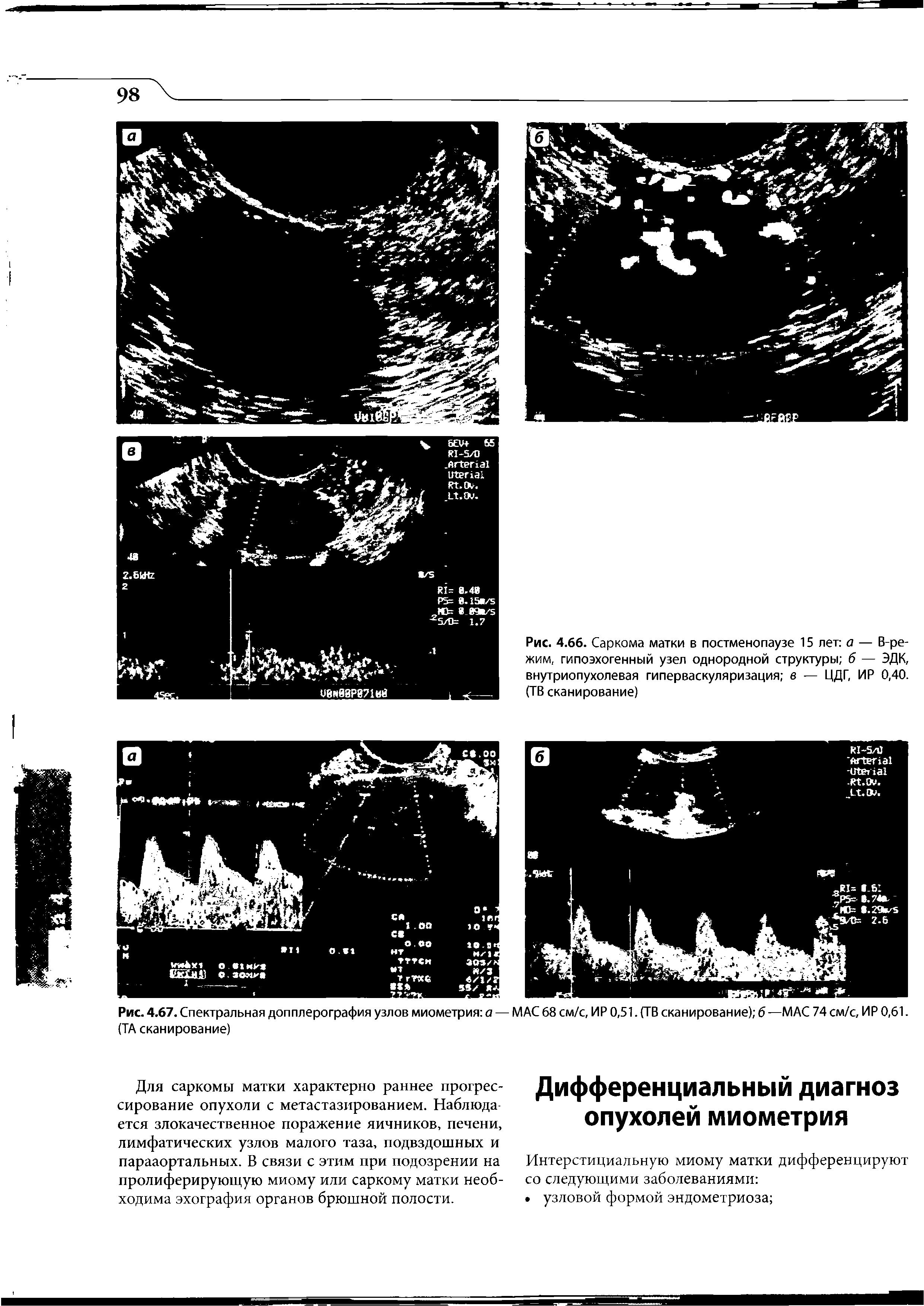 Рис. 4.66. Саркома матки в постменопаузе 15 лет а — В-ре-жим, гипоэхогенный узел однородной структуры б — ЭДК, внутриопухолевая гиперваскуляризация в — ЦДГ, ИР 0,40. (ТВ сканирование)...