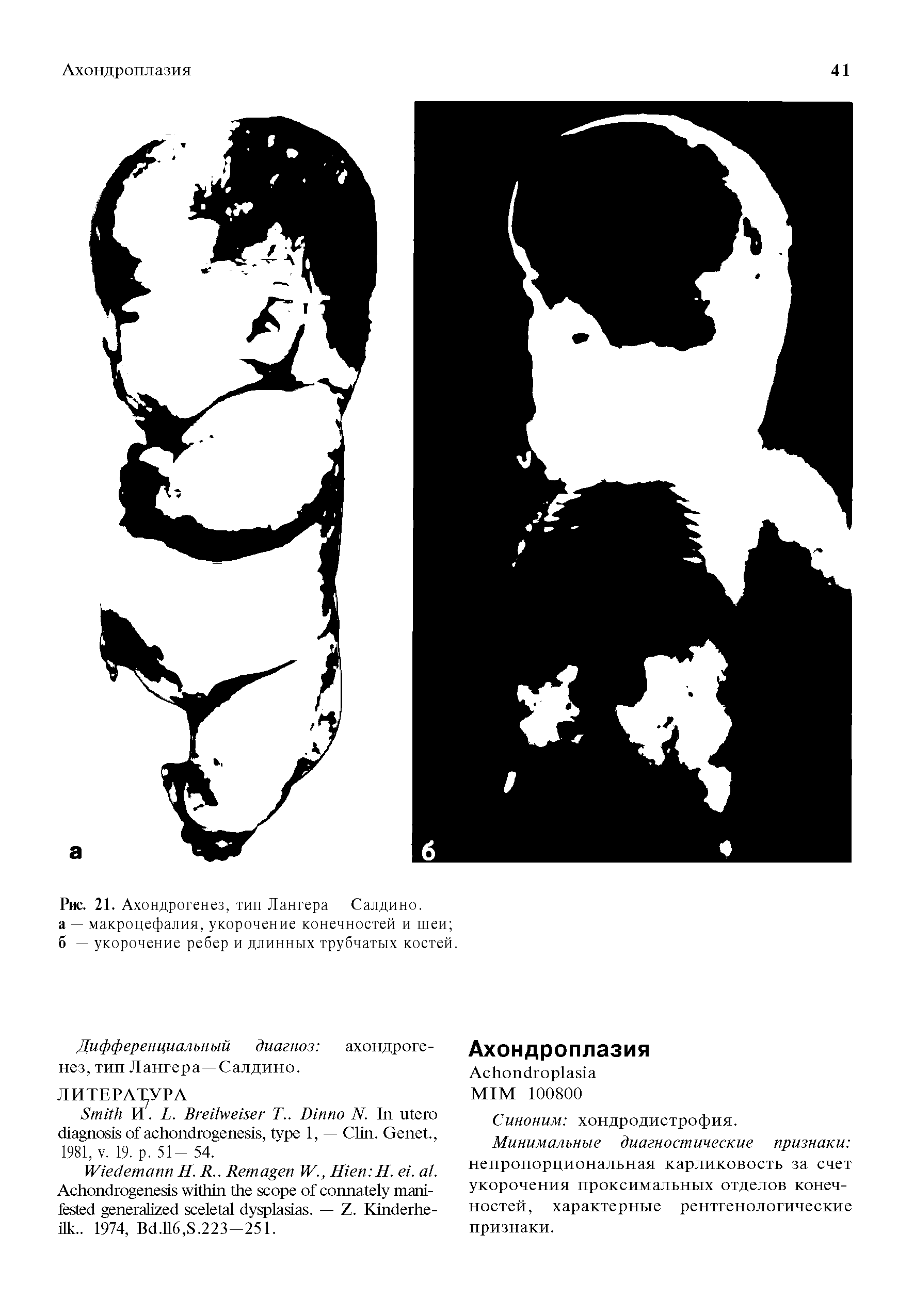 Рис. 21. Ахондрогенез, тип Лангера Салдино. а — макроцефалия, укорочение конечностей и шеи б — укорочение ребер и длинных трубчатых костей.