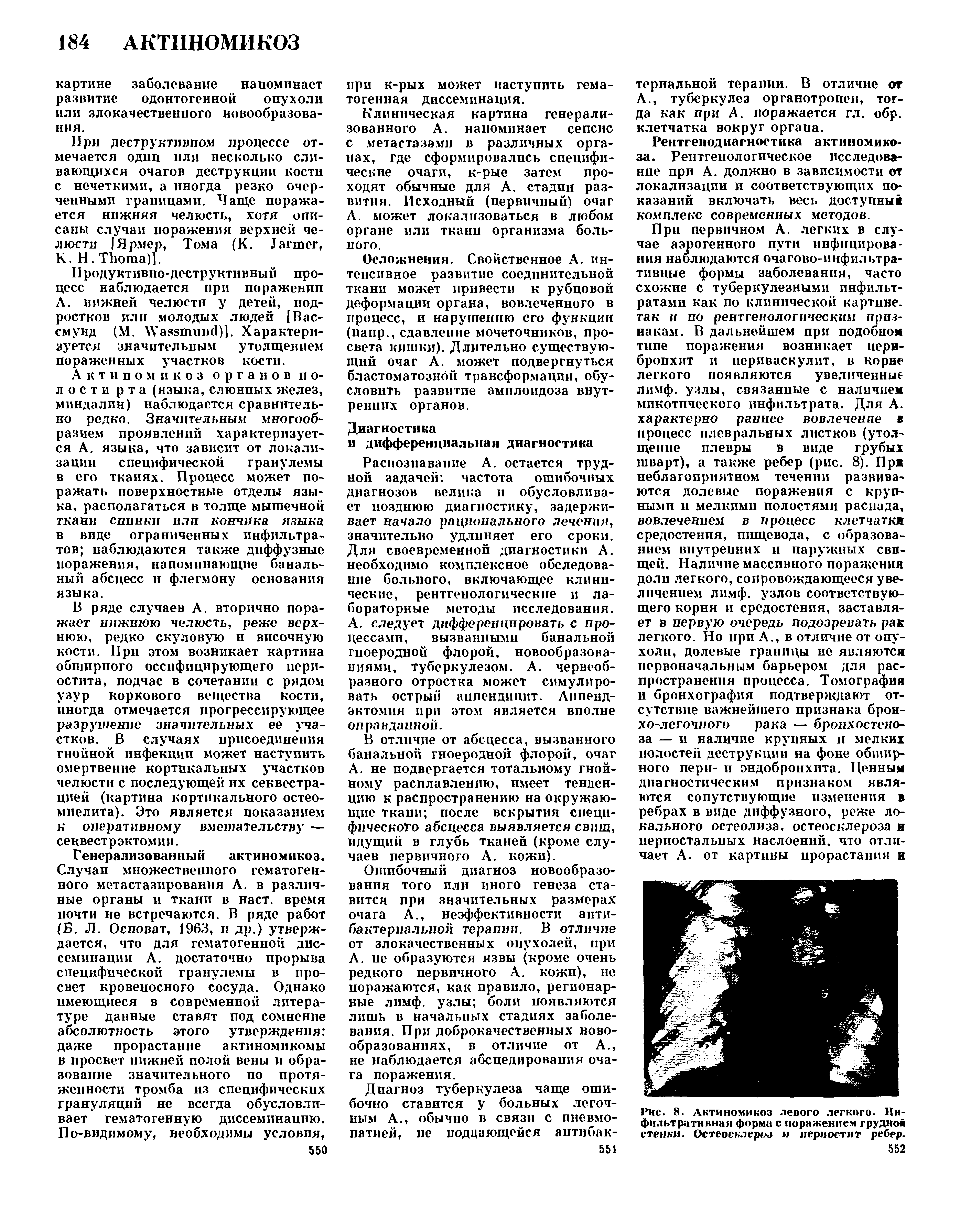 Рис. 8. Актиномикоз левого легкого. Инфильтративная форма с поражением грудной стенки. Остеосклероз и периостит ребер.