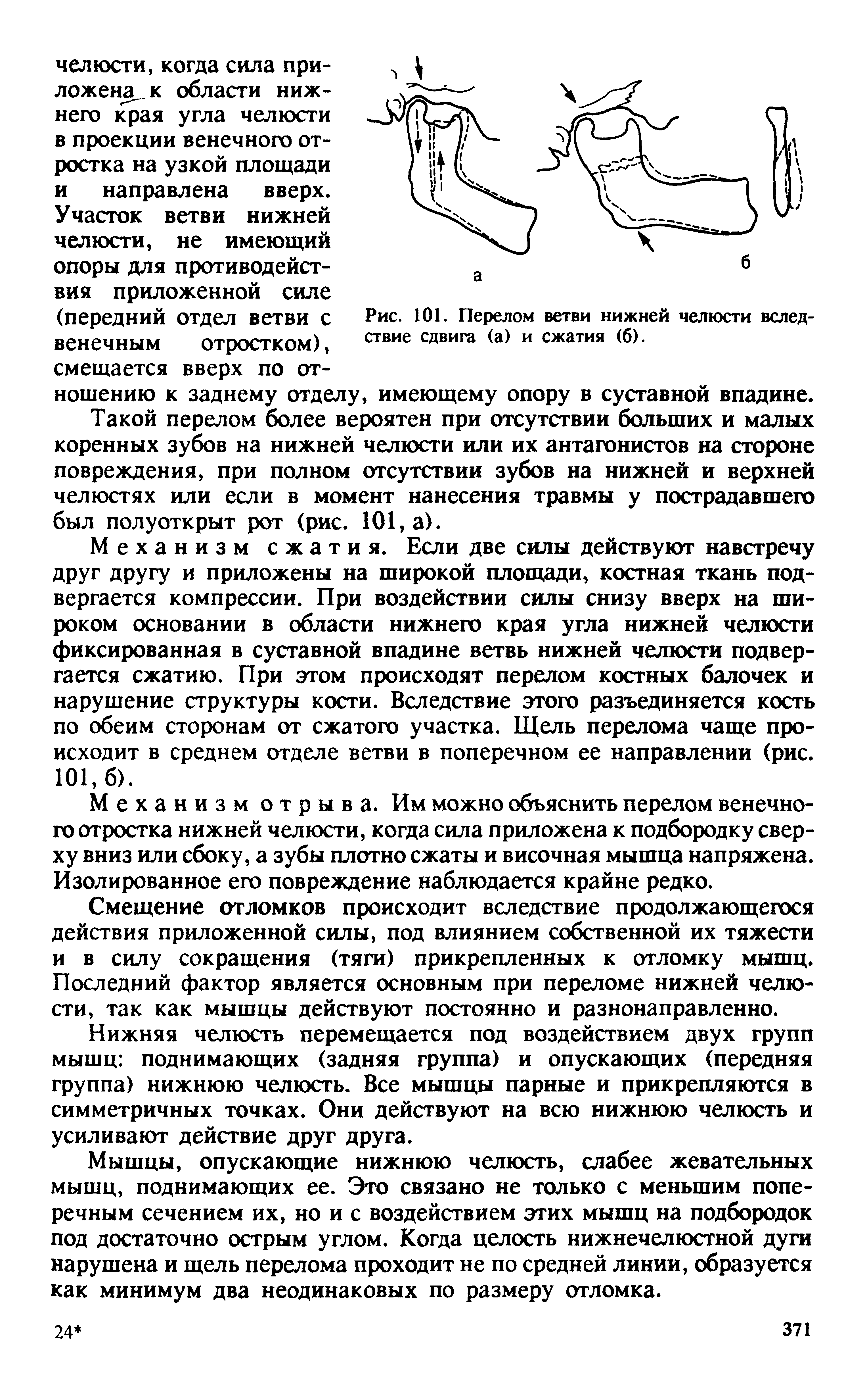 Рис. 101. Перелом ветви нижней челюсти вследствие сдвига (а) и сжатия (б).