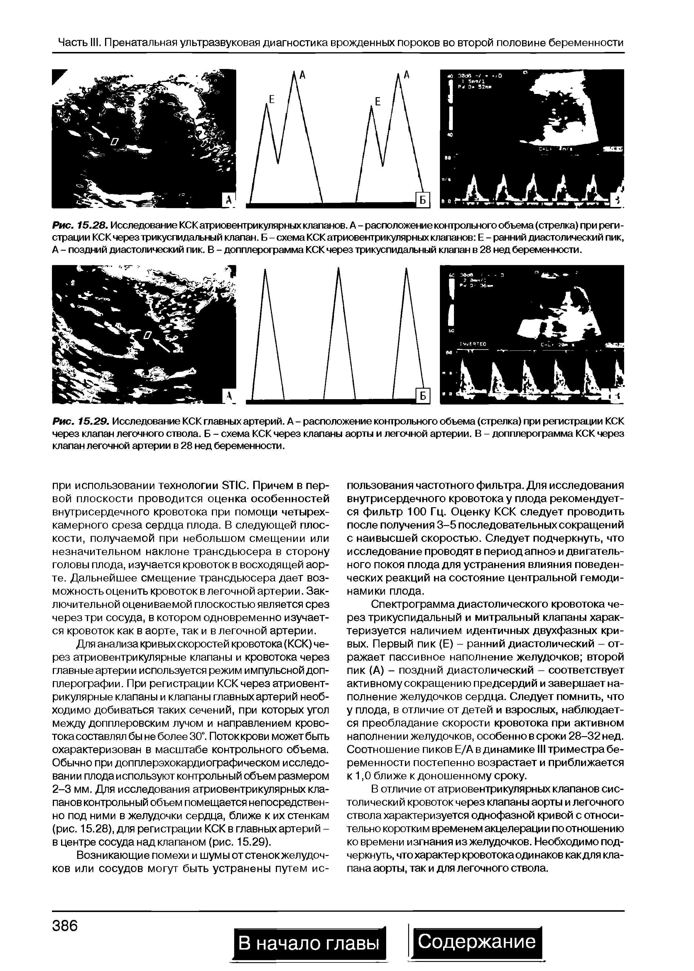 Рис. 15.28. Исследование КСК атриовентрикулярных клапанов. А - расположение контрольного объема (стрелка) при регистрации КСК через трикуспидальный клапан. Б - схема КСК атриовентрикулярных клапанов Е - ранний диастолический пик, А - поздний диастолический пик. В - допплерограмма КСК через трикуспидальный клапан в 28 нед беременности.