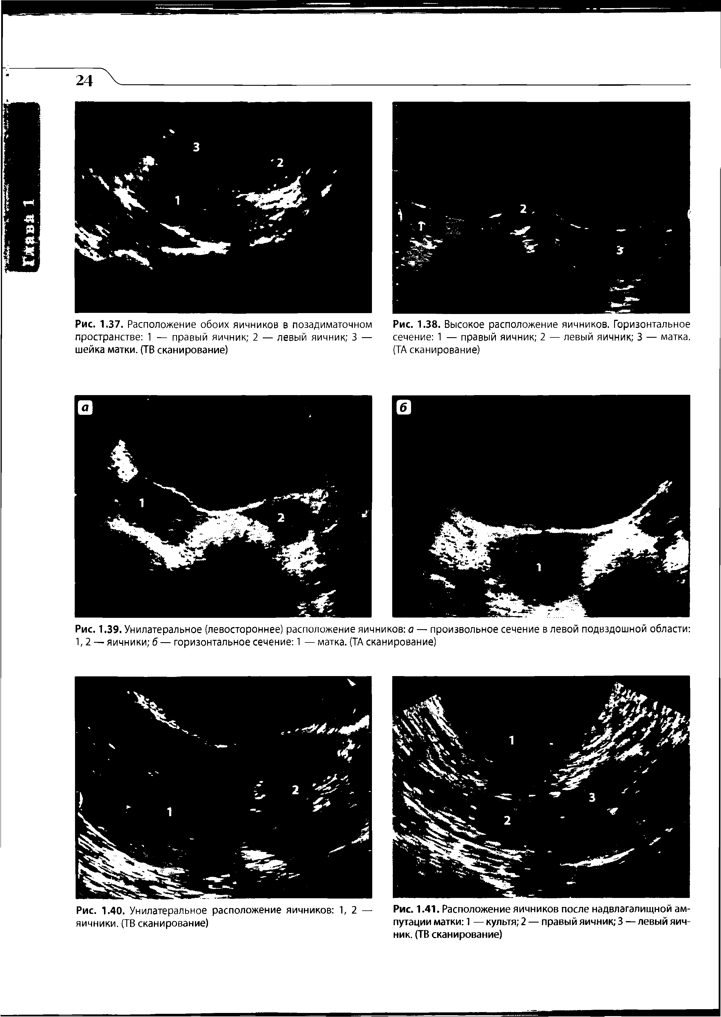 Рис. 1.41. Расположение яичников после надвлагалищной ампутации матки 1 — культя 2 — правый яичник 3 — левый яичник. (ТВ сканирование)...