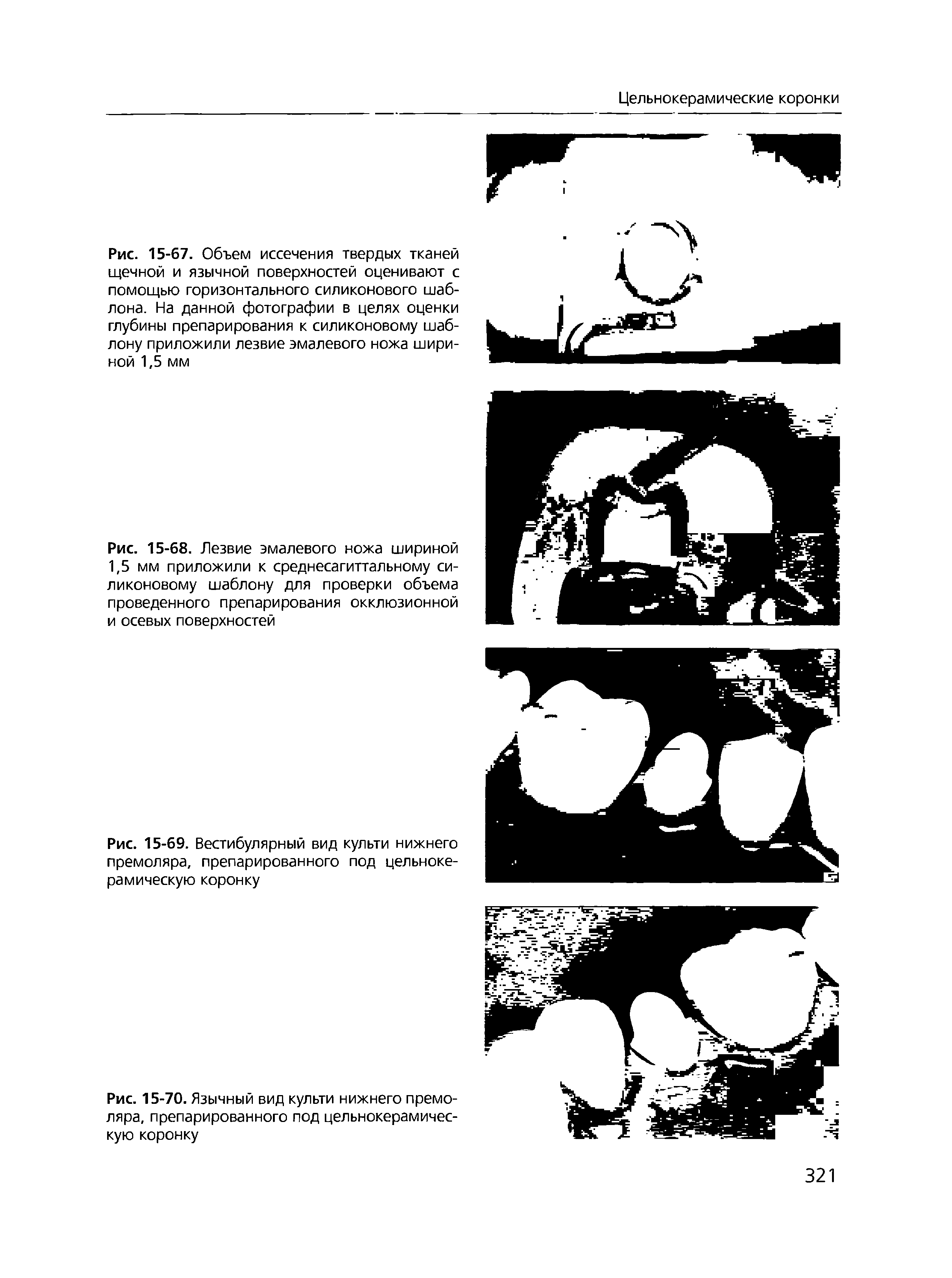 Рис. 15-69. Вестибулярный вид культи нижнего премоляра, препарированного под цельнокерамическую коронку...