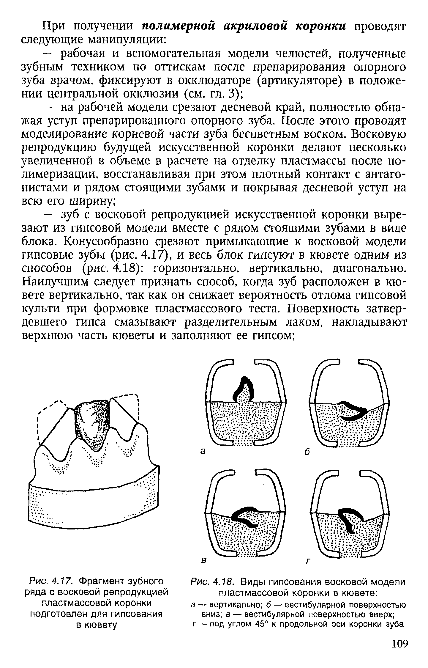 Рис. 4.18. Виды гипсования восковой модели пластмассовой коронки в кювете ...