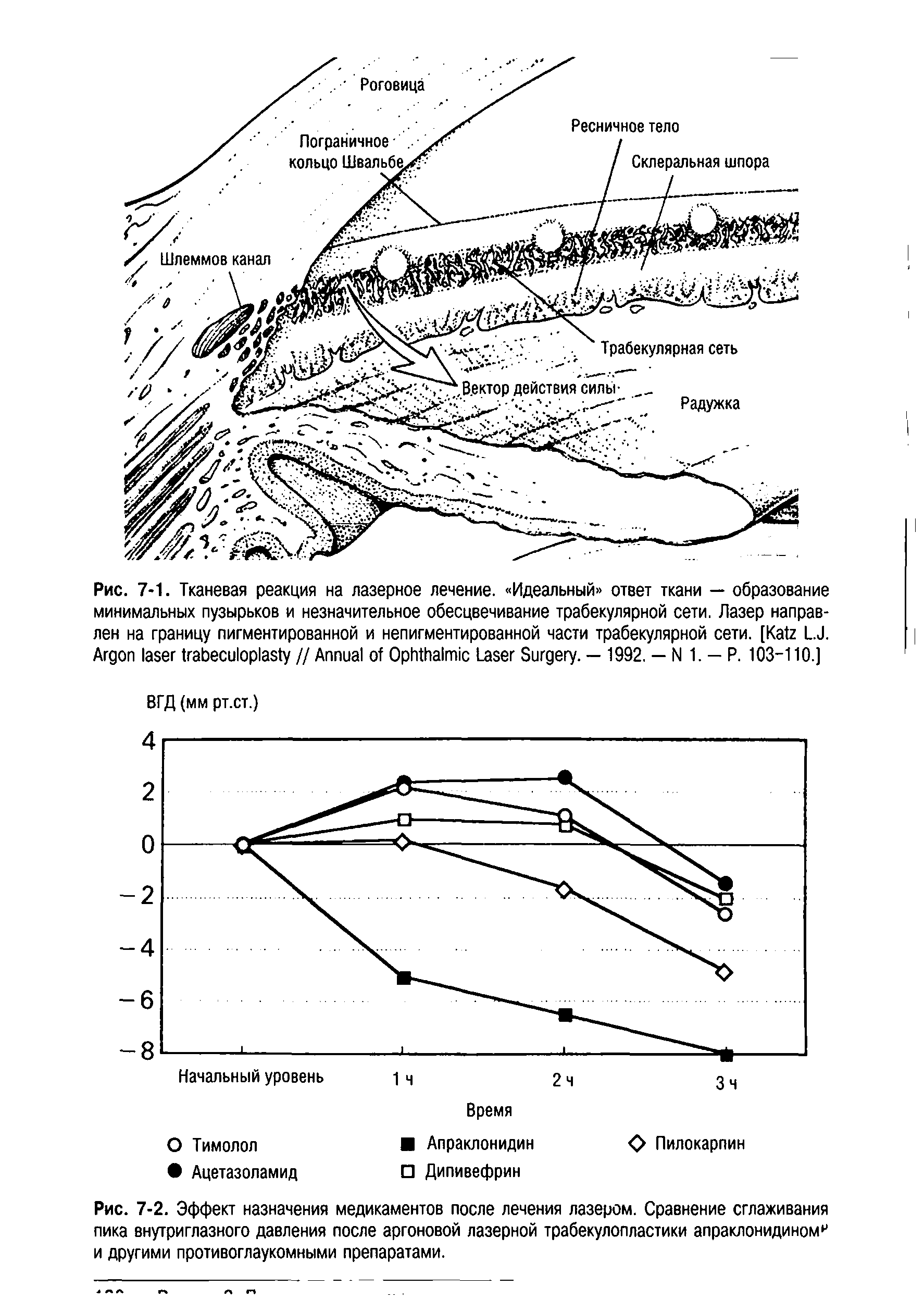 Рис. 7-2. Эффект назначения медикаментов после лечения лазером. Сравнение сглаживания пика внутриглазного давления после аргоновой лазерной трабекулопластики апраклонидиномр и другими противоглаукомными препаратами.
