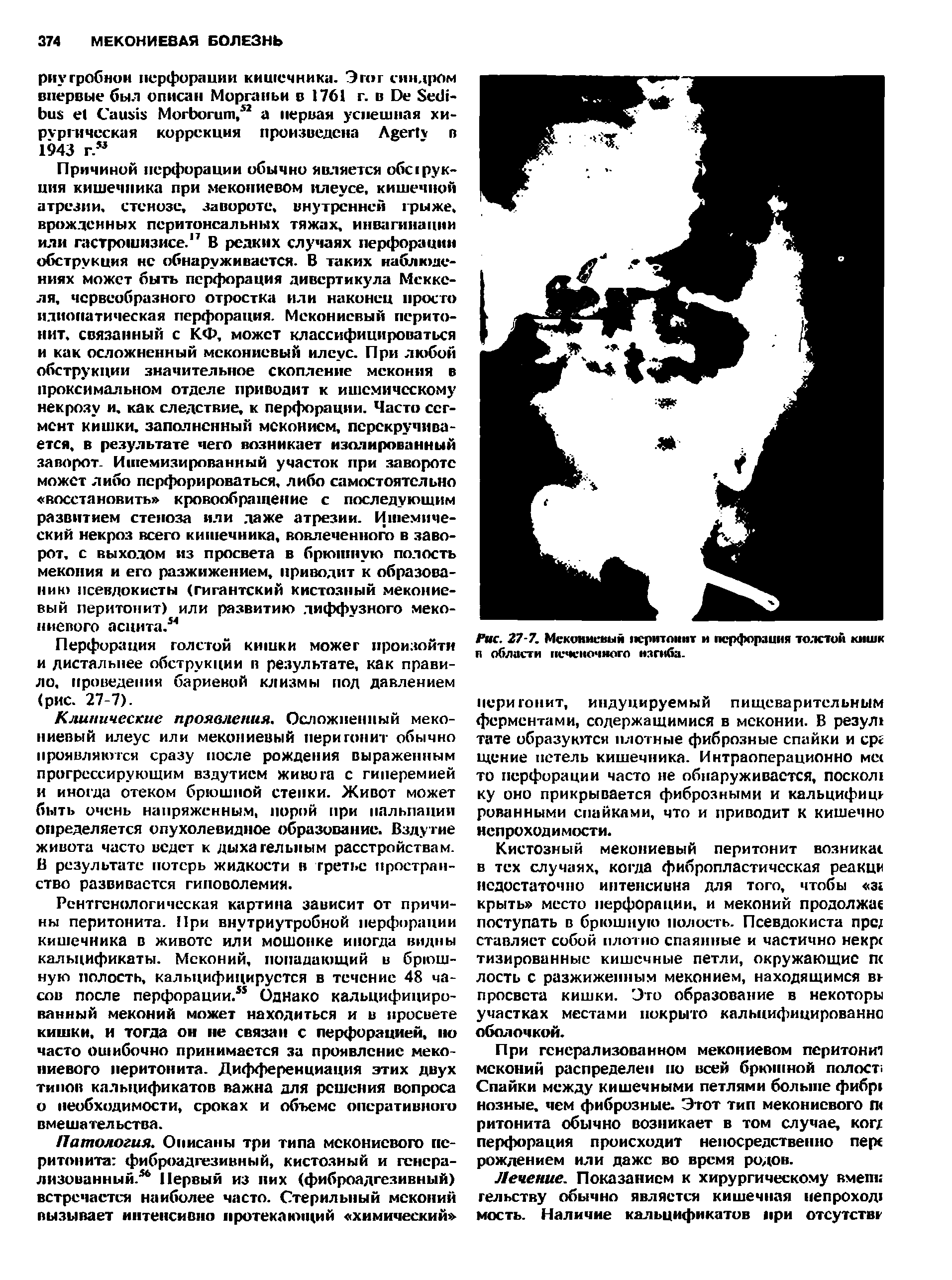 Рис. Z7-7. Мекониевый перитонит и перфорация толстой кишк п области печеночного изгиба.