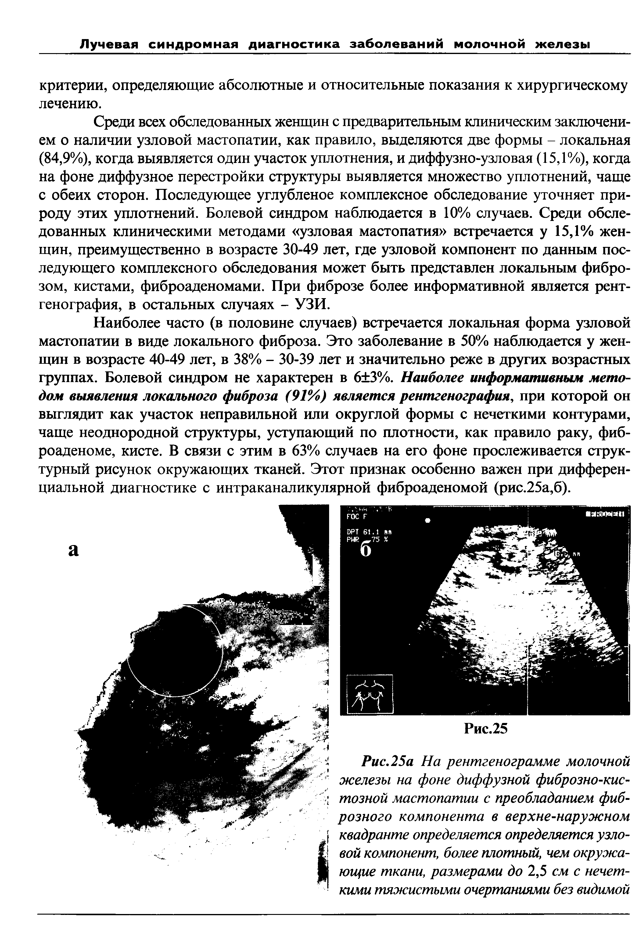 Рис.25а На рентгенограмме молочной железы на фоне диффузной фиброзно-кистозной мастопатии с преобладанием фиброзного компонента в верхне-наружном квадранте определяется определяется узловой компонент, более плотный, чем окружающие ткани, размерами до 2,5 см с нечеткими тяжистыми очертаниями без видимой...