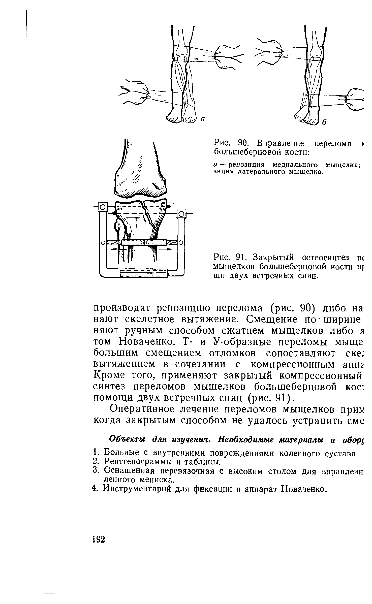 Рис. 91. Закрытый остеосинтез п( мыщелков большеберцовой костн п[ щи двух встречных спиц.