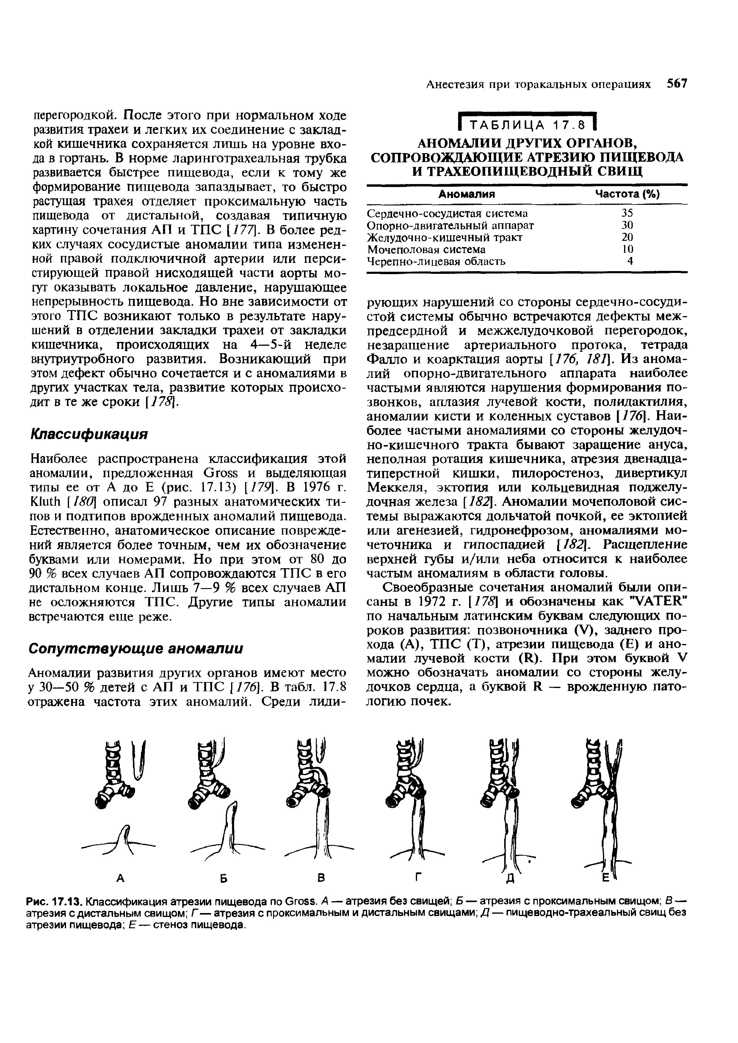 Рис. 17.13. Классификация атрезии пищевода по G . А — атрезия без свищей Б — атрезия с проксимальным свищом В — атрезия с дистальным свищом Г — атрезия с проксимальным и дистальным свищами Д — пищеводно-трахеальный свищ без атрезии пищевода Е — стеноз пищевода.